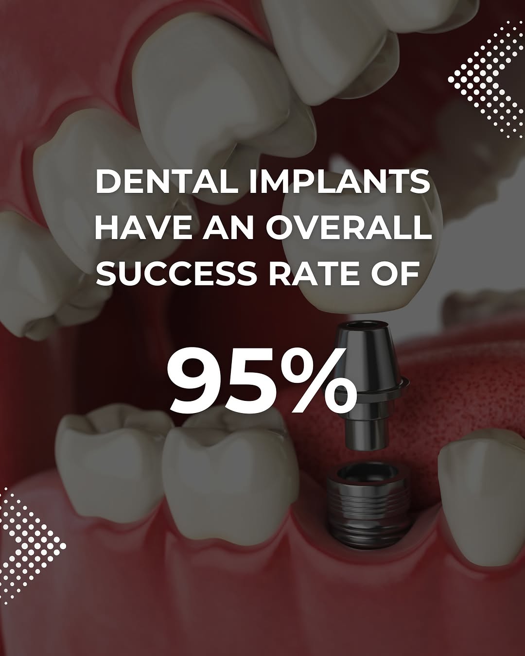 Instagram post by Dr. James A. Kraus, D: Dental implants = the gold standard for tooth replacement! ✨ Unlike dentures or bridges, implants fuse with your jawbone, preserving bone he…