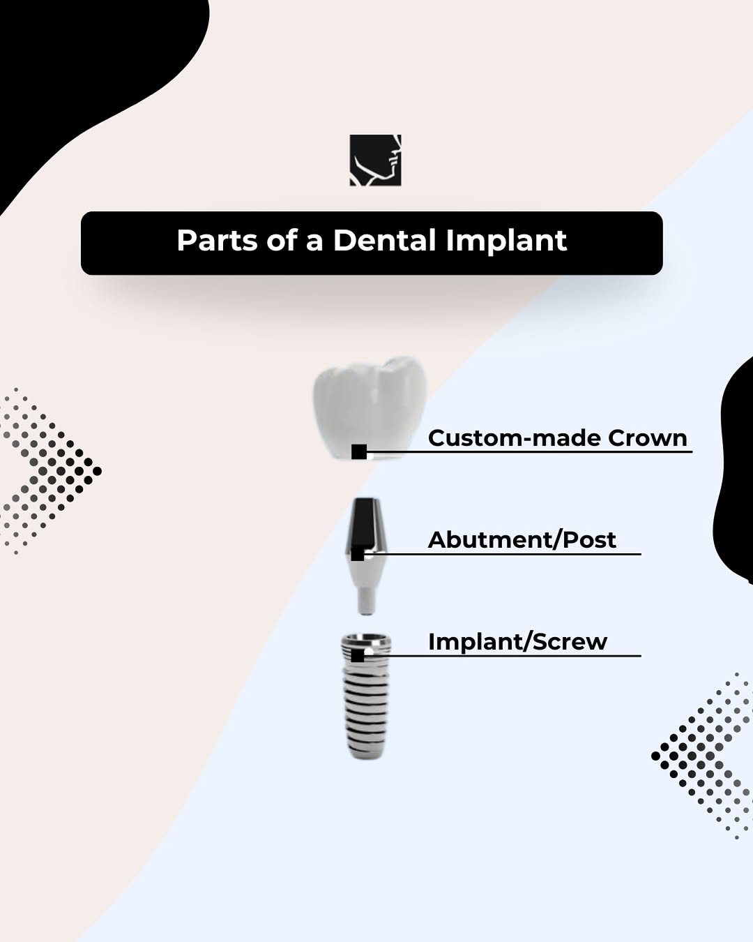 Instagram post by Dr. James A. Kraus, D: Ever wonder what makes up a dental implant? It has three main parts: the implant post (like an artificial tooth root), the abutment (connect…