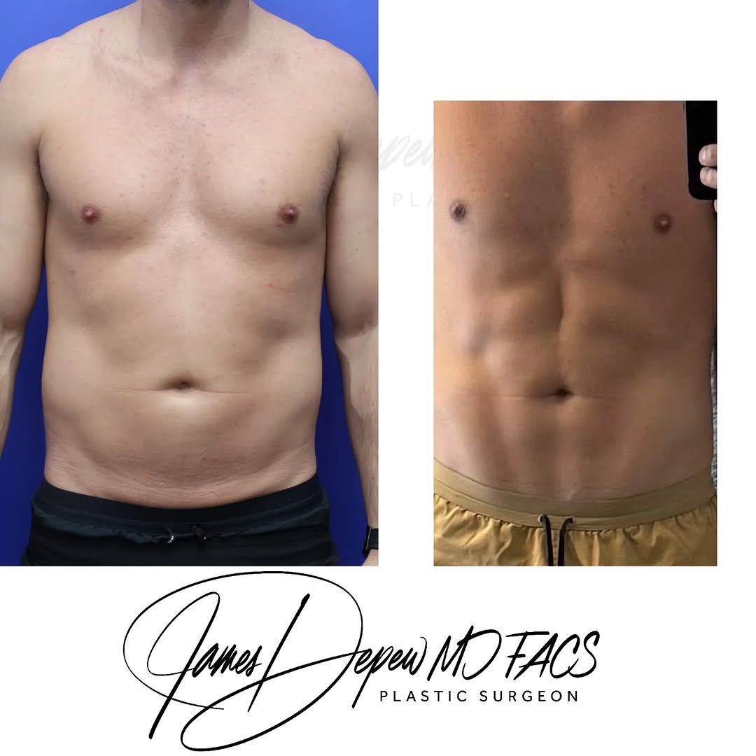 Instagram post by Dr. James B. Depew: After 2 rounds of Ellacor non surgical skin reduction, all the hard work really shines through to show off those abs! Thanks to my amazing p…