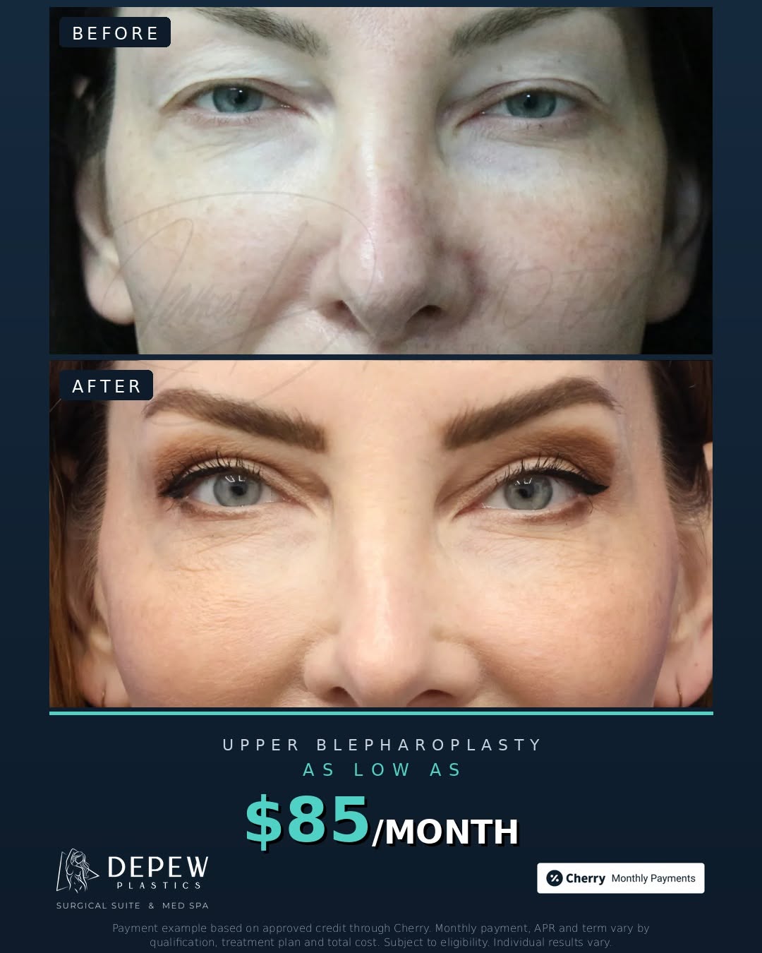 Instagram post by Dr. James B. Depew: Look at the BEFORE. That heavy fold of upper lid skin resting on her lashes — the thing that made her look exhausted no matter how much she …