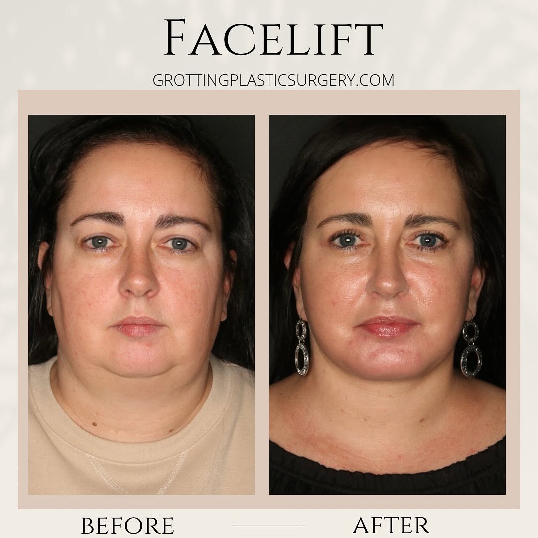Instagram post by Dr. James C. Grotting: A heavy neck is often genetic and can be fixed if it bothers you! We are so happy for our patient and she loves her result! She is just thre…