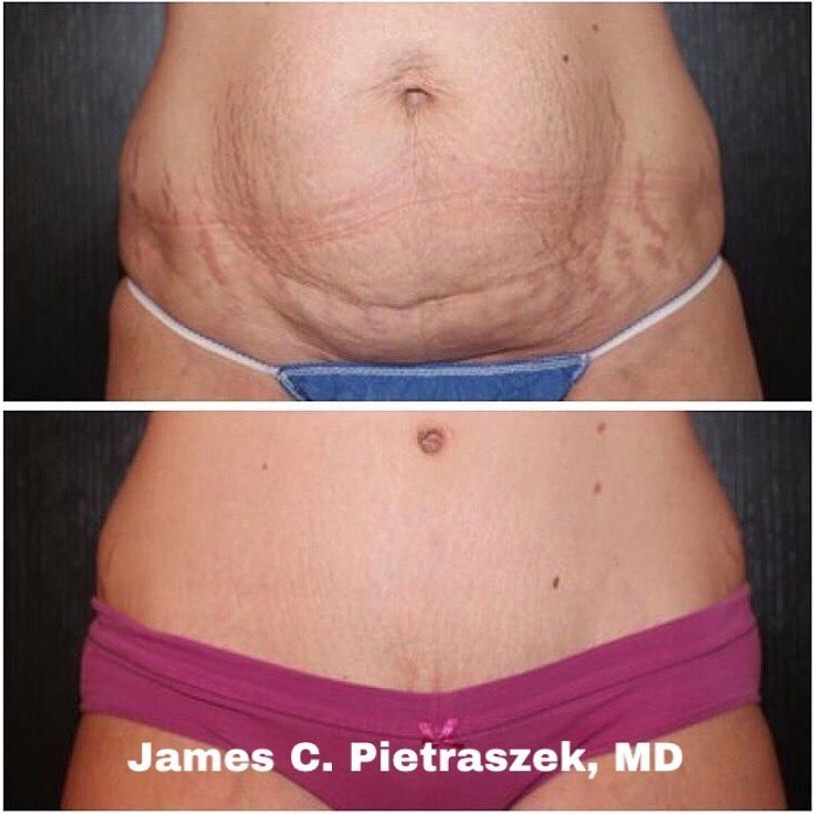 Instagram post by Dr. James C. Pietraszek: Abdominoplasty before and after . . . . . #beforeandafterplasticsurgery #followmee #plasticsurgeryclinic #liposuction #likesforlike #lowerbo…