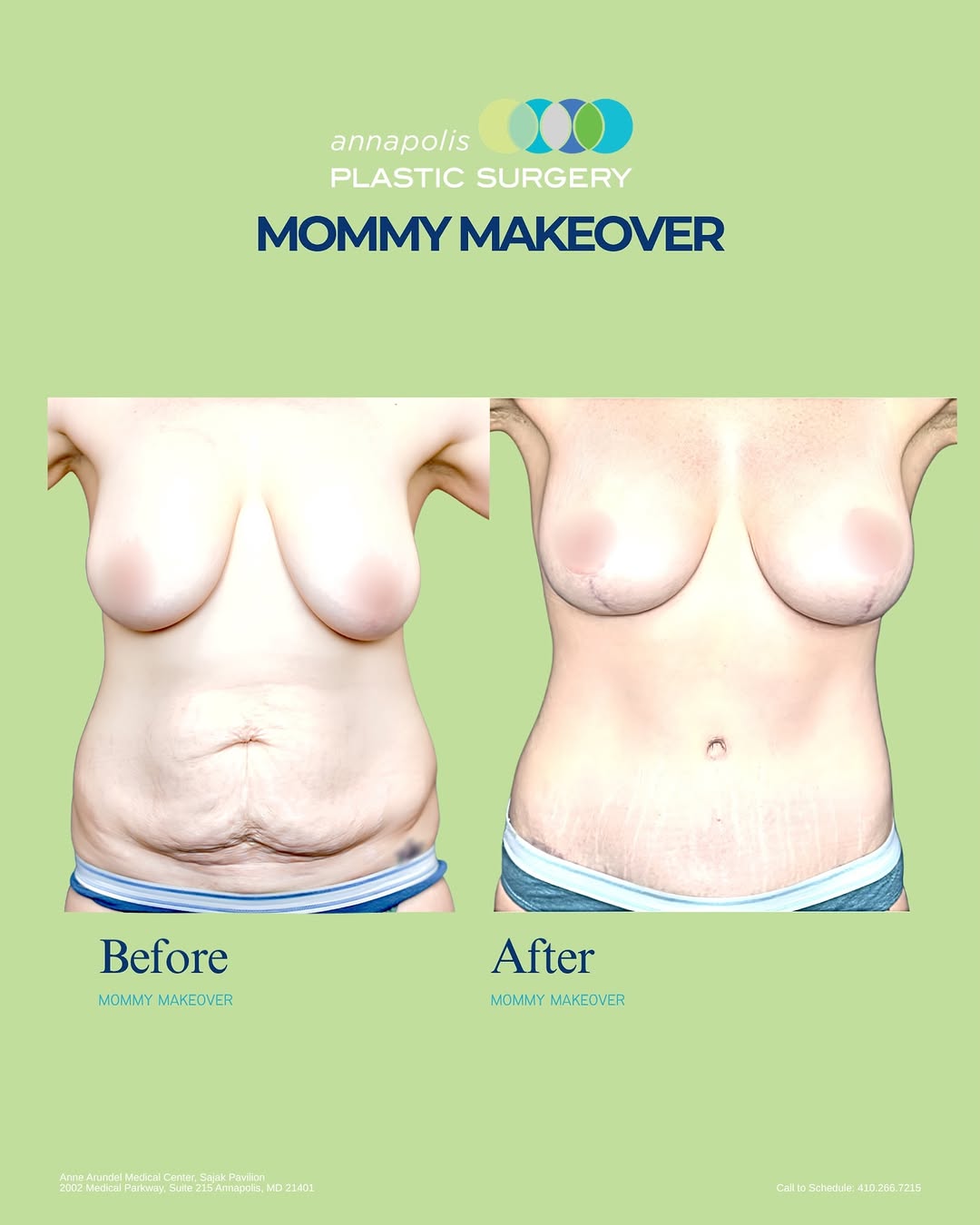 Instagram post by Dr. James E. Chappell: A mommy makeover is about you! giving your body a second chance and helping you feel confident and comfortable in your own skin again. Pregn…
