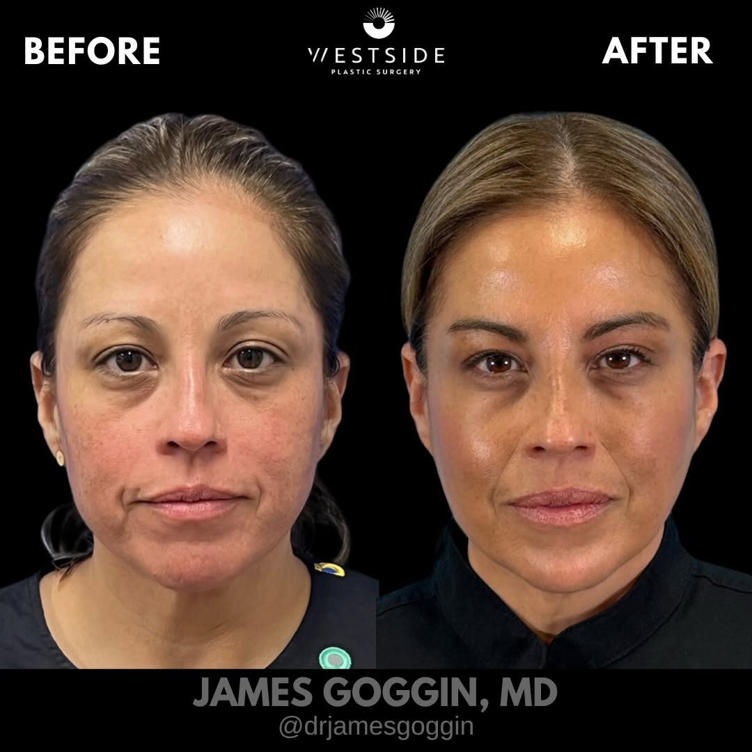 Instagram post by Dr. James Goggin: A comprehensive approach to non-surgical facial rejuvenation. For this patient, Sculptra + RF Microneedling played a major role in improving…