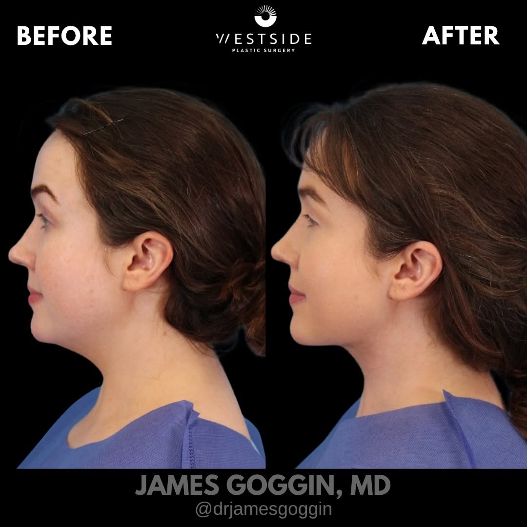 Instagram post by Dr. James Goggin: Neck Contouring | Platysmaplasty + Deep Fat Resection At 29, this patient had loss of definition along the jawline and neckline, with limite…