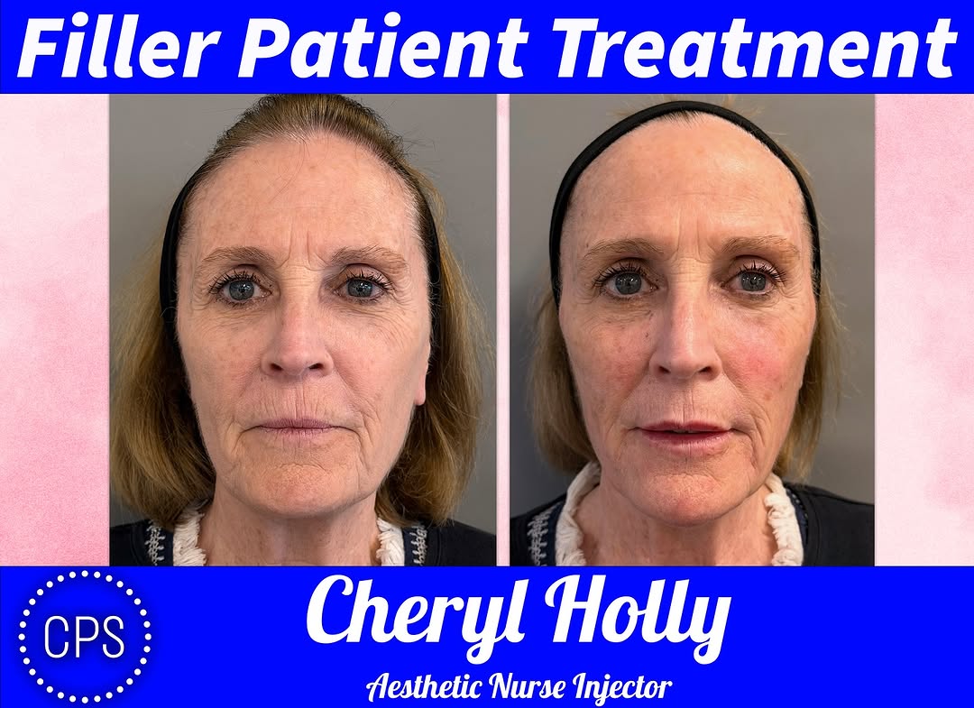 Instagram post by Dr. James H. French Jr.: Subtle changes. Powerful transformation. ✨ This beautiful full-face rejuvenation was achieved using a customized treatment plan with 12 syri…