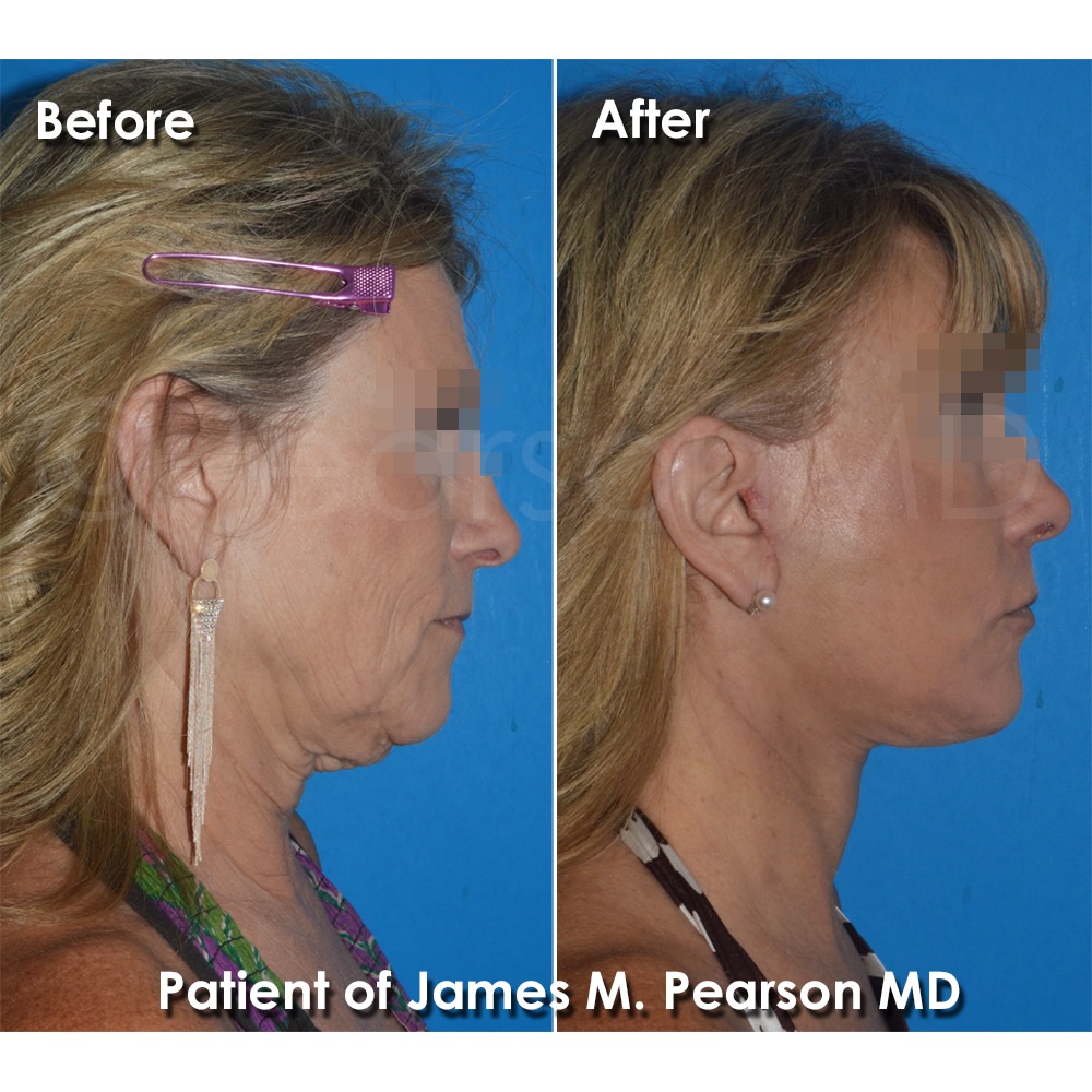 Instagram post by Dr. James M. Pearson: . Facelift / Neck Lift ~ 2 weeks . Pleased to see our beautiful patient's progress 2 weeks following her deep-plane #facelift and #necklift …