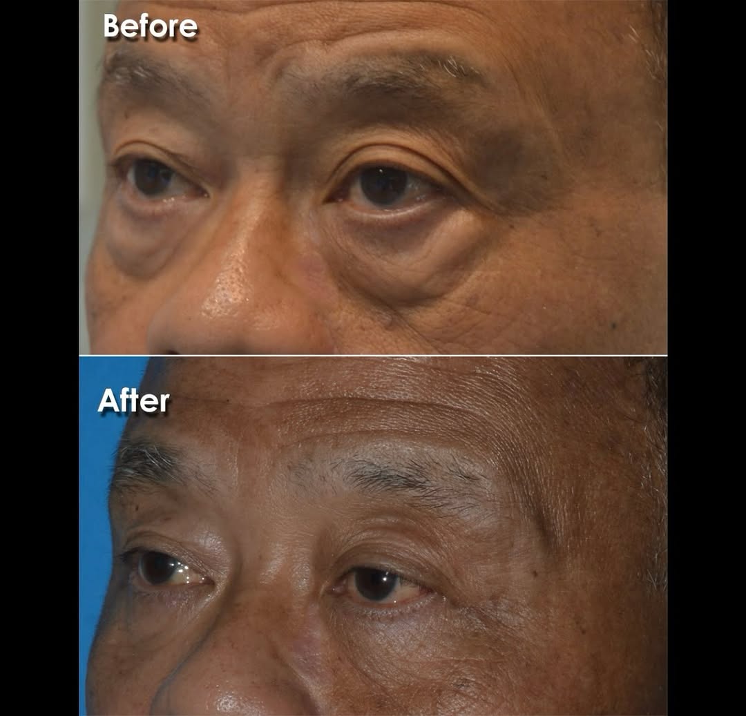 Instagram post by Dr. James M. Pearson: . Lower eyelid blepharoplasty . Under-eye shadows and an associated tired look are a common concern of patients seeking facial rejuvenation …