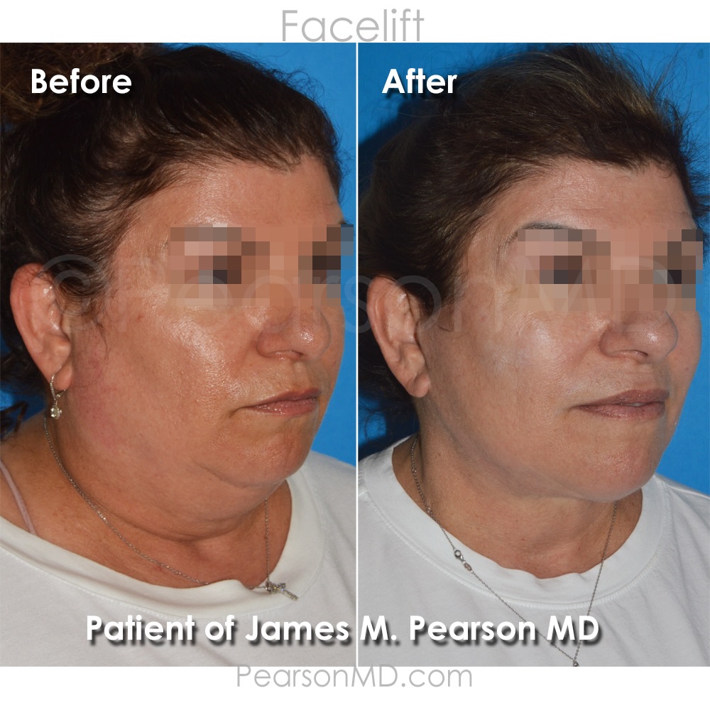 Instagram post by Dr. James M. Pearson: . Facelift / Neck Lift . Pleased to see our beautiful patient's progress a few months following her deep-plane #facelift and #necklift . . F…