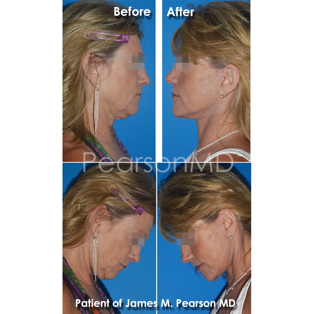 Instagram post by Dr. James M. Pearson: . Facelift / Neck Lift ~ 6 weeks . Pleased to see our beautiful patient's progress 6 weeks following her deep-plane #facelift and #necklift …