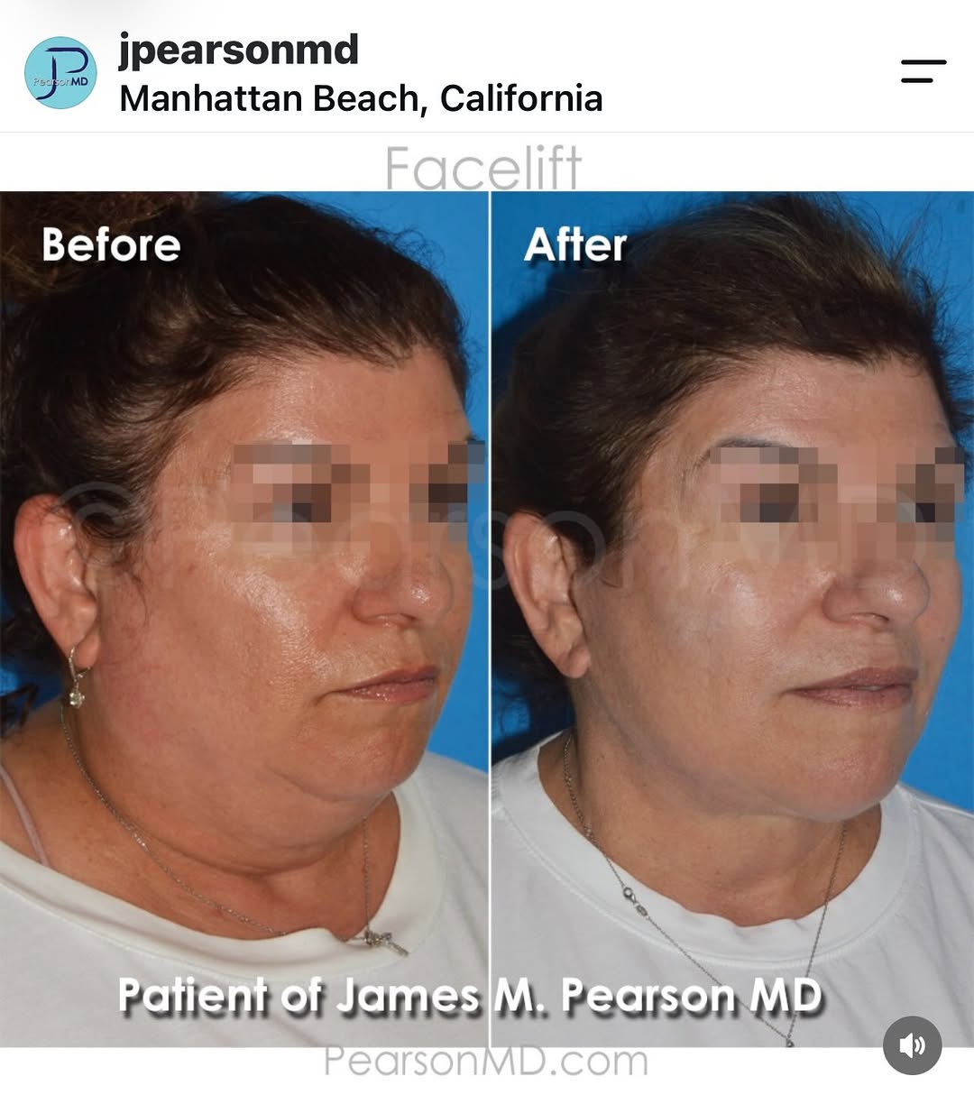Instagram post by Dr. James M. Pearson: I really debated whether to share this, because having a deep-plane facelift and neck lift is about so much more than the exterior result fo…