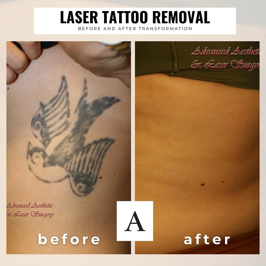 Instagram post by Dr. James McMahan: Stunning result from our previous client! Look how seamless the transformation is from the old tattoo to being not there at all 😍 If you ha…