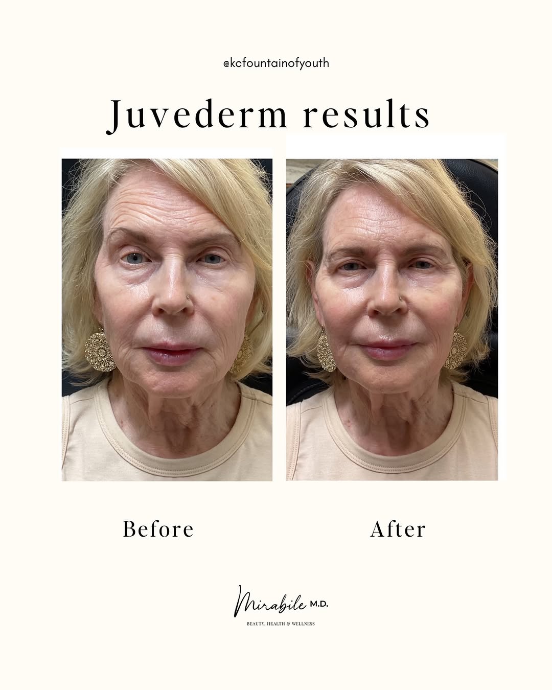 Instagram post by Dr. James Mirabile: A little volume can make a big difference. 🤍 This beautiful refresh focused on restoring balance and support where it matters most. We used…