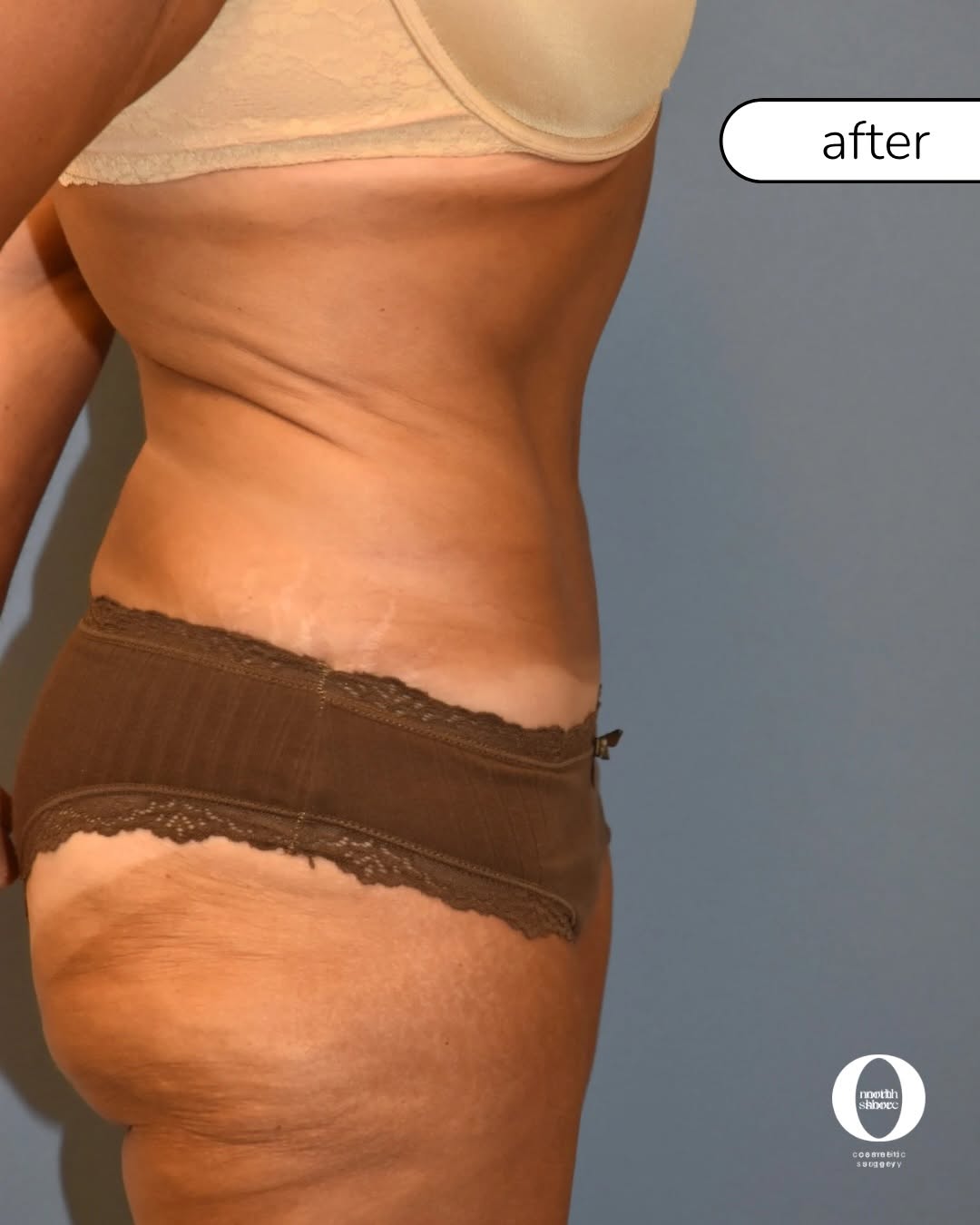 Instagram post by Dr. James N. Romanelli: Over 100lbs lost. Two pregnancies. And a transformation worth celebrating ✨👙 This beautiful patient underwent a Fleur-de-Lis Abdominoplasty…