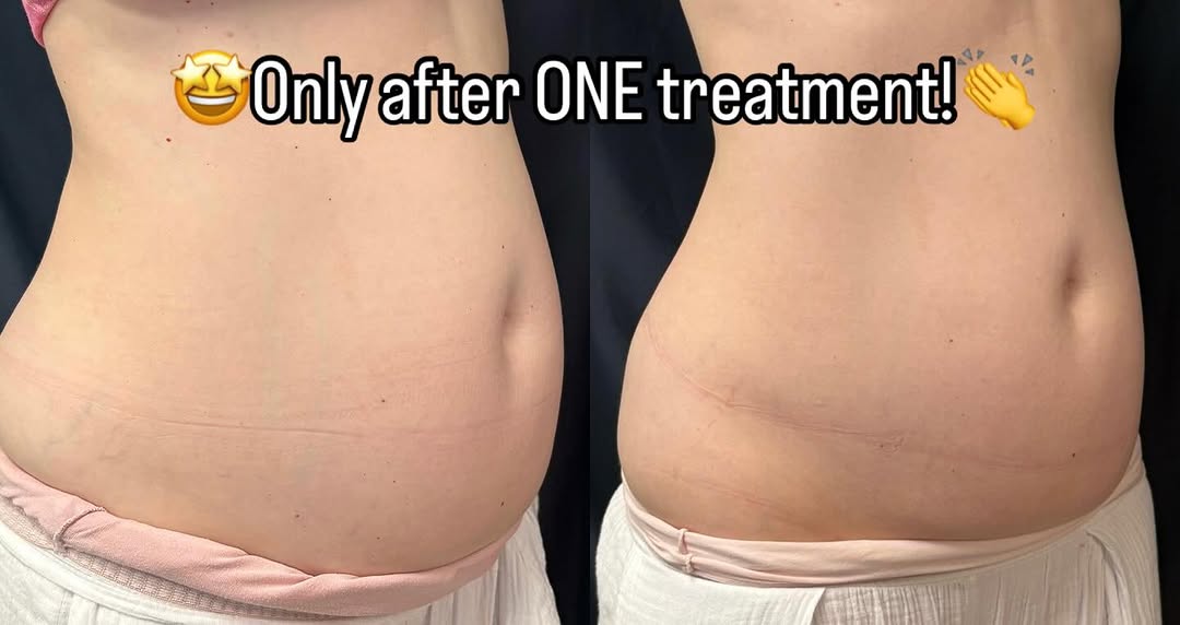Instagram post by Dr. James Okamoto: Amazing results with SculpSure! Need an incentive to shrink your belly fat? Start with SculpSure! #sculpsure #bellyfat #bodysculping #fatlos…