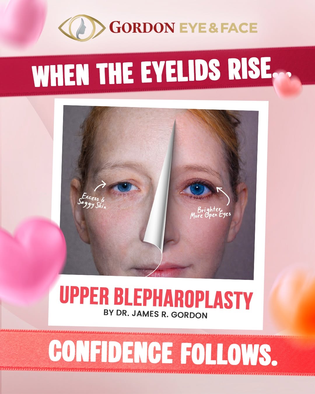 Instagram post by Dr. James R. Gordon: Love your eyes a little extra this Valentineโs Day โค๏ธโจ Swipe to see how thoughtfully performed eyelid surgery can restore a brighter, more rโฆ