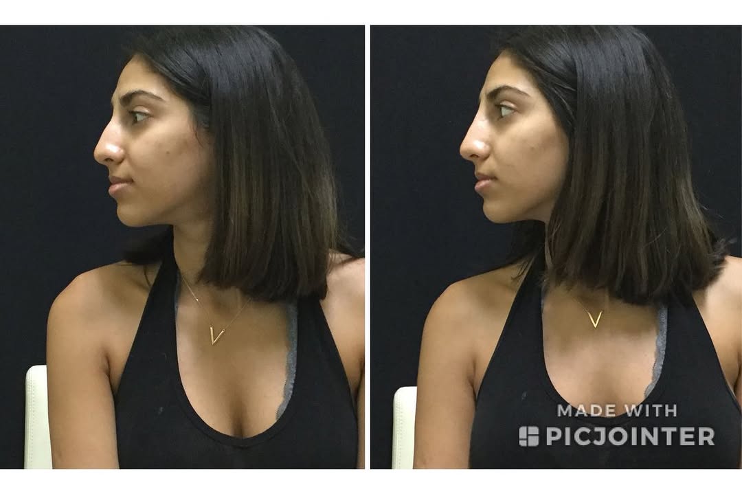 Instagram post by Dr. Jamshid Tamiry: Non-surgical rhinoplasty HautSpa Medica by Dr. Tamiry Subtle gentle non-surgical nose job performed with Filler. In this case the patient ha…