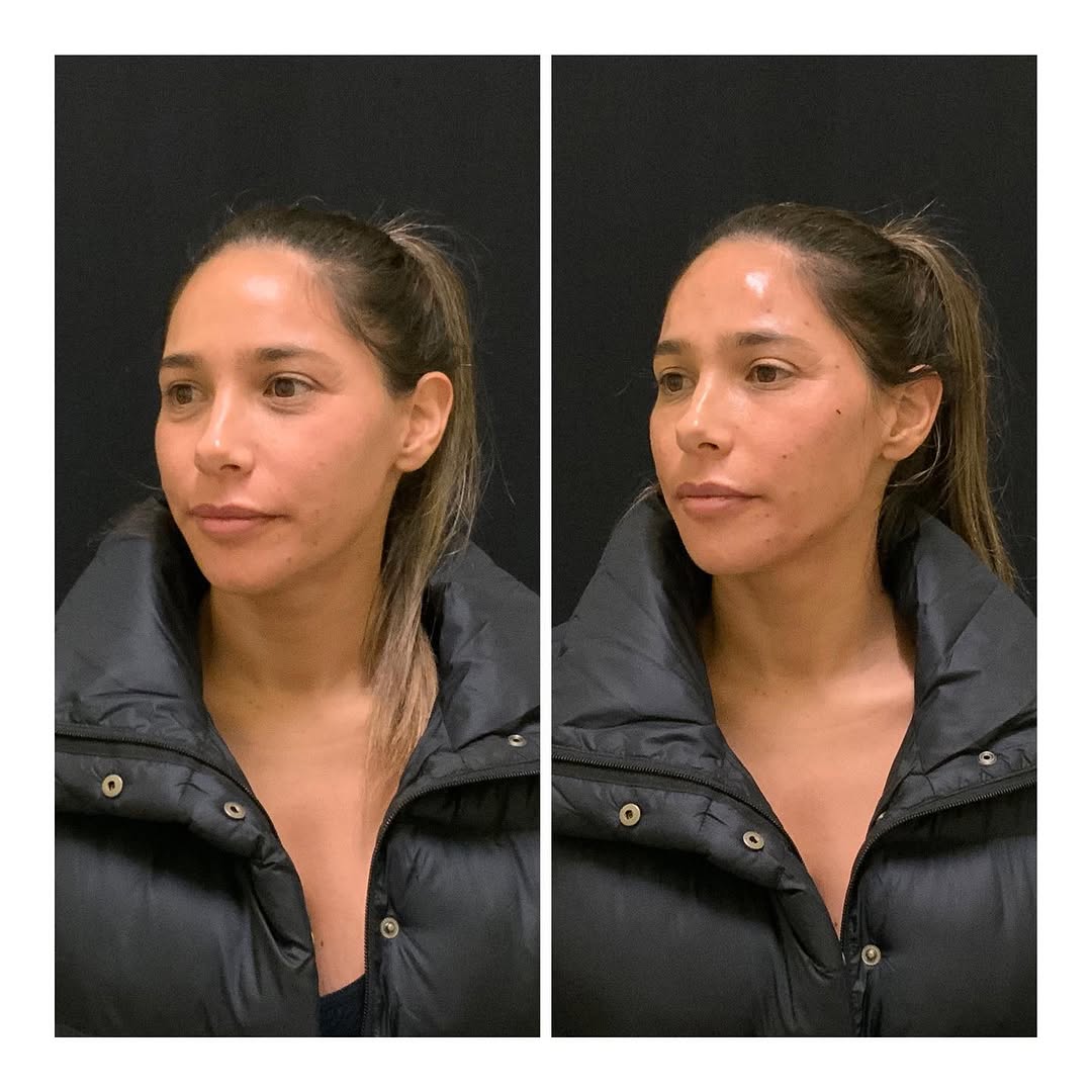 Instagram post by Dr. Jamshid Tamiry: Tear Trough, Jawline and Chin Contouring B&A Dark circles around the eyes are a combination of hereditary, & #volume loss due to variety of …