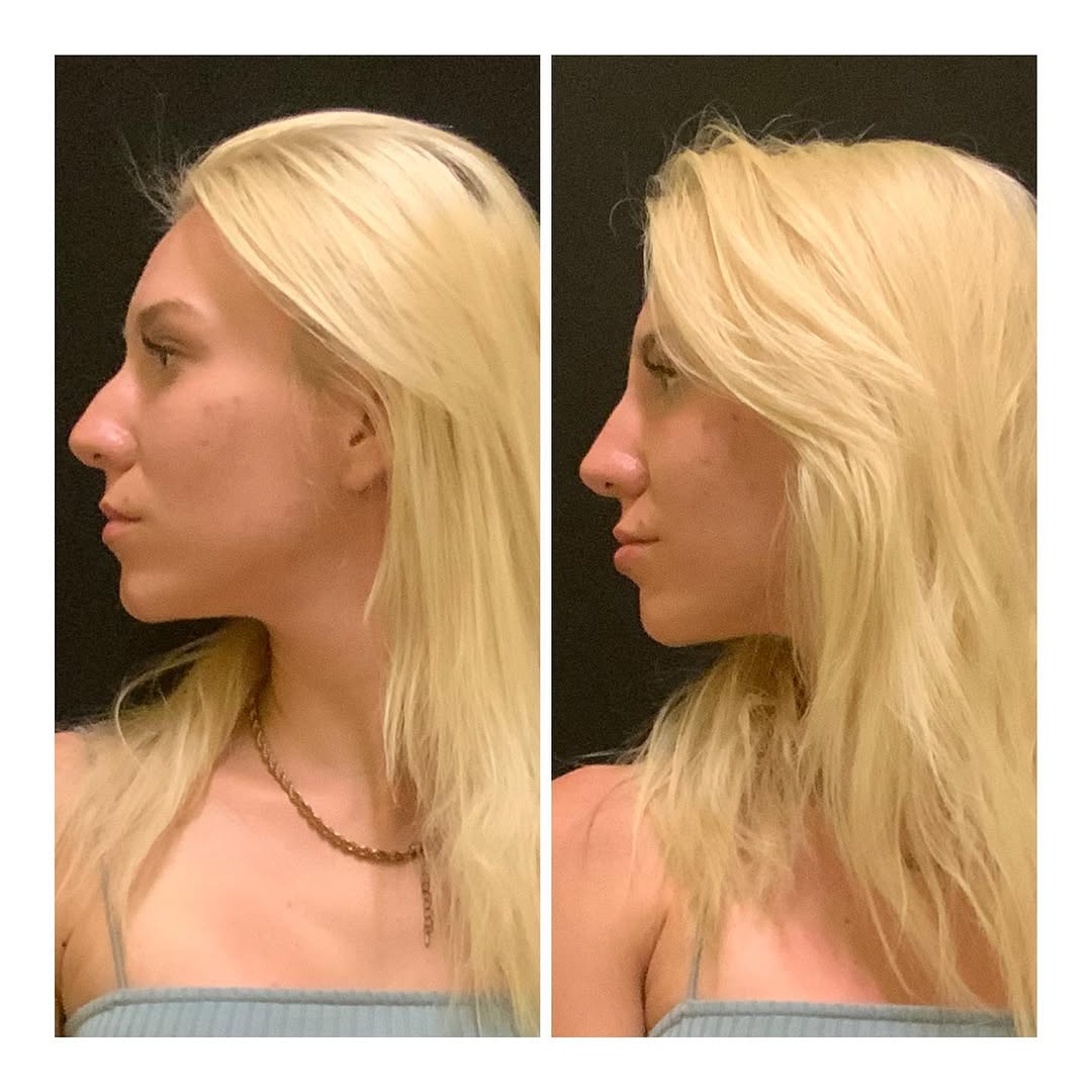 Instagram post by Dr. Jamshid Tamiry: Non- Surgical Rhinoplasty HautSpa Medica by Dr. Tamiry Duration:1-2 years Bruising: minimal Downtime: none Anesthesia: as needed- none #nose…