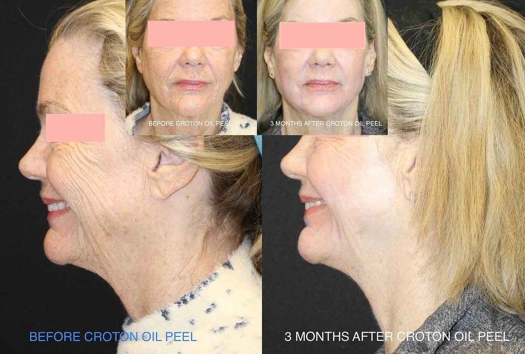 Instagram post by Dr. Jane Weston: I love happy patients! — (And I’m so thankful when they give me permission to share their before and after photos!)