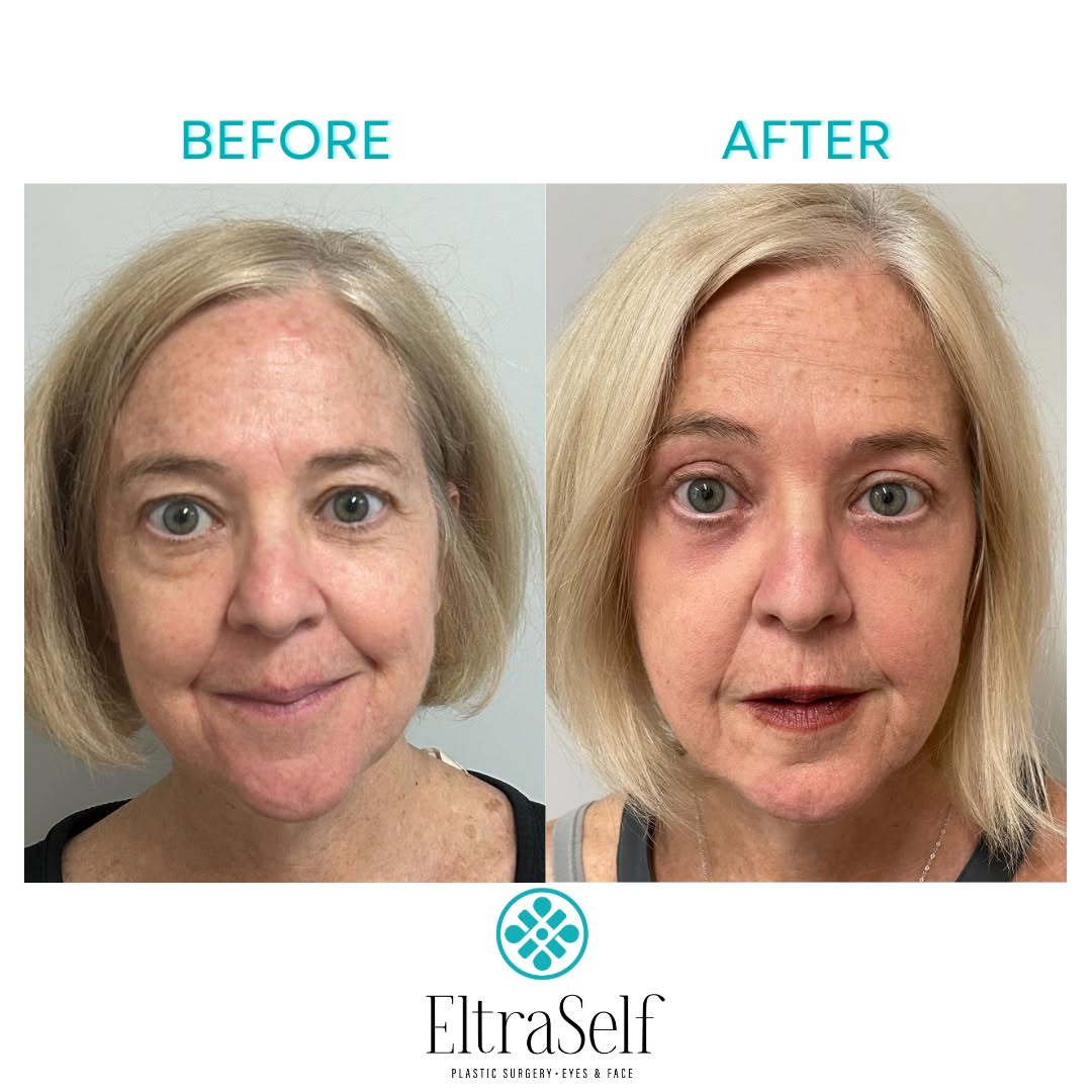 Instagram post by Dr. Janet M. Neigel: This beautiful patient is 1 month post-op after an upper Blepharoplasty & browpexy along with a lower Blepharoplasty with Fx laser. The resu…