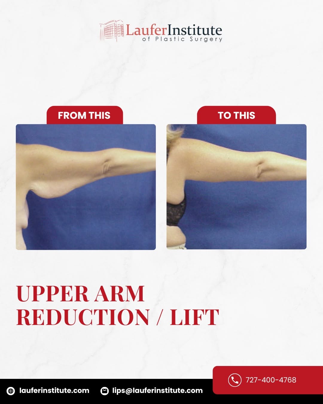 Instagram post by Dr. Jared Gopman: 🔔 Struggling with loose or sagging upper arm skin? Even with exercise and weight loss, excess skin in the upper arms often doesn’t tigh…