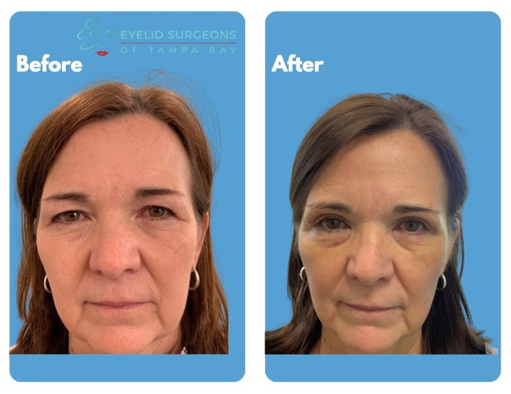 Instagram post by Dr. Jasmine Mohadjer: A one week transformation! This nice lady had an upper blepharoplasty that immediately improved her vision and made her look 10 years younge…