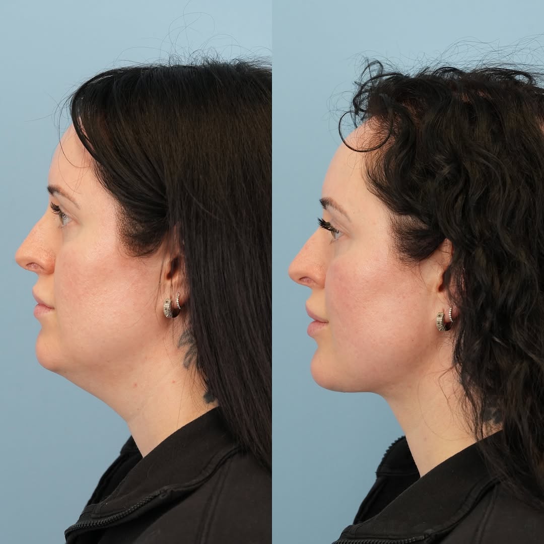 Instagram post by Dr. Jason D. Bloom: You may have seen this wonderful patient as she has been healing from her deep neck lift, but her final results are 🔥! You can really see h…