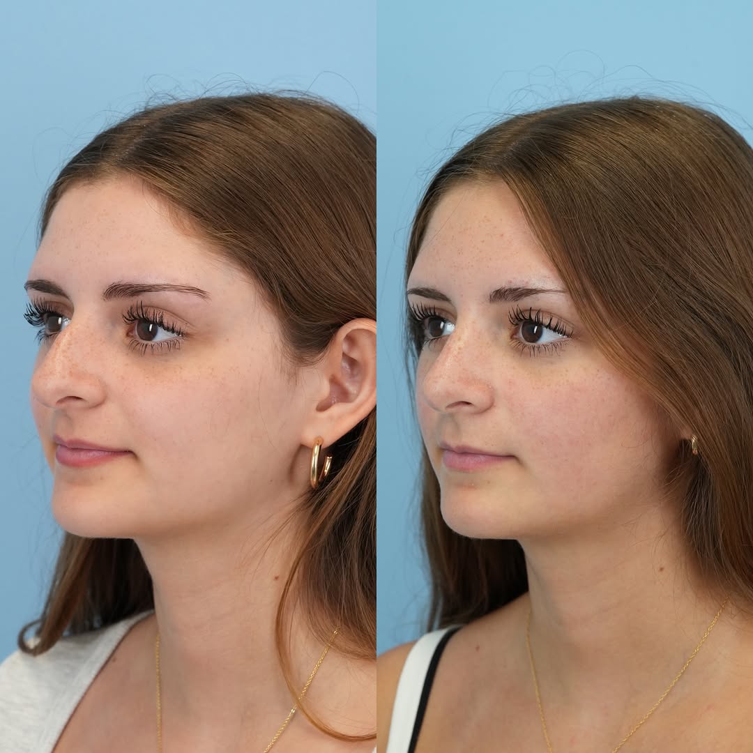 Instagram post by Dr. Jason D. Bloom: Looking great now and only getting better! 👃🏻🔥 This lovely patient is only 6 weeks out from her endonasal, scarless rhinoplasty and looks…