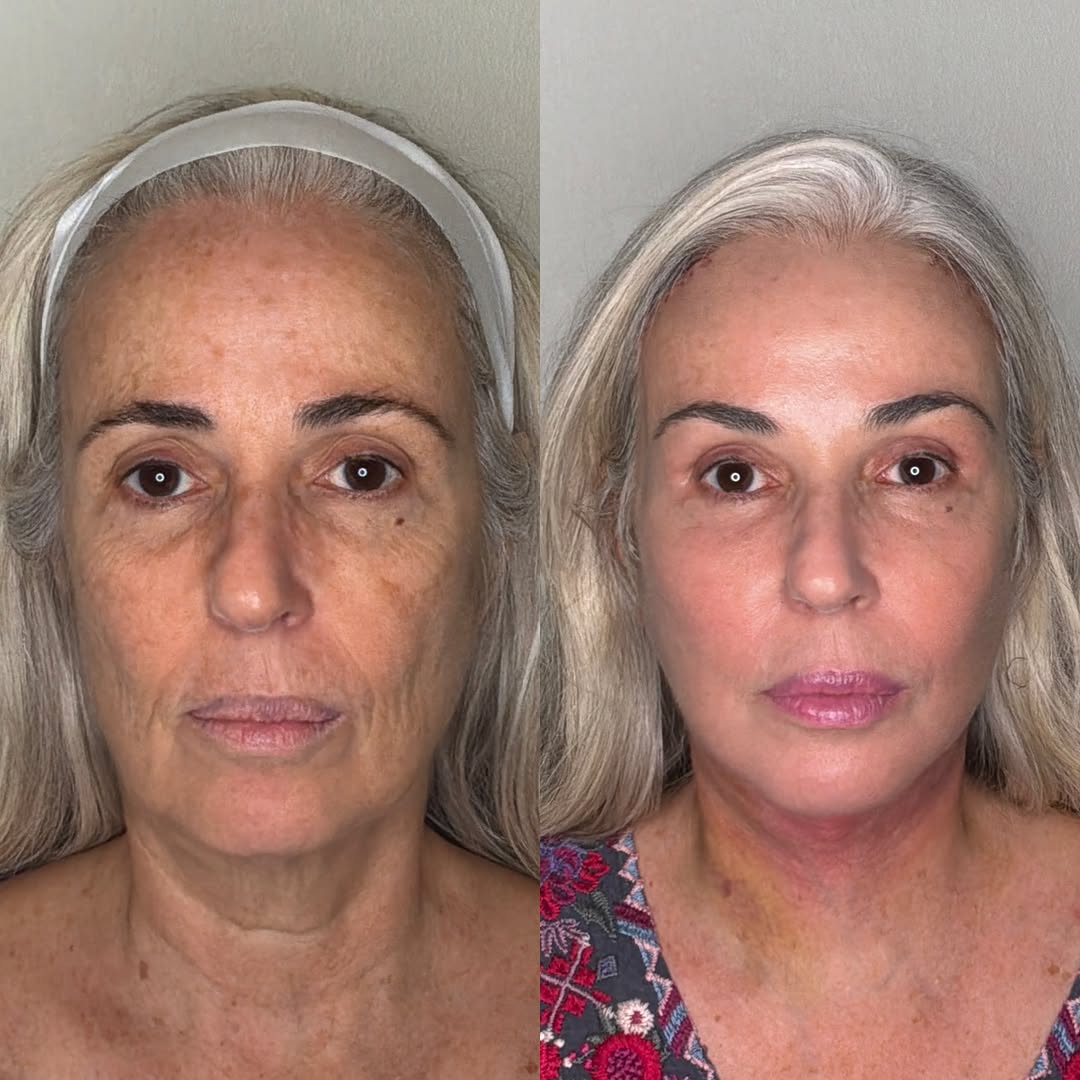 Instagram post by Dr. Jason Gardenier: FACELIFT AND NECKLIFT: Our patient is shown here early after a facelift and necklift with central facial fat grafting, brow lift, and laser …