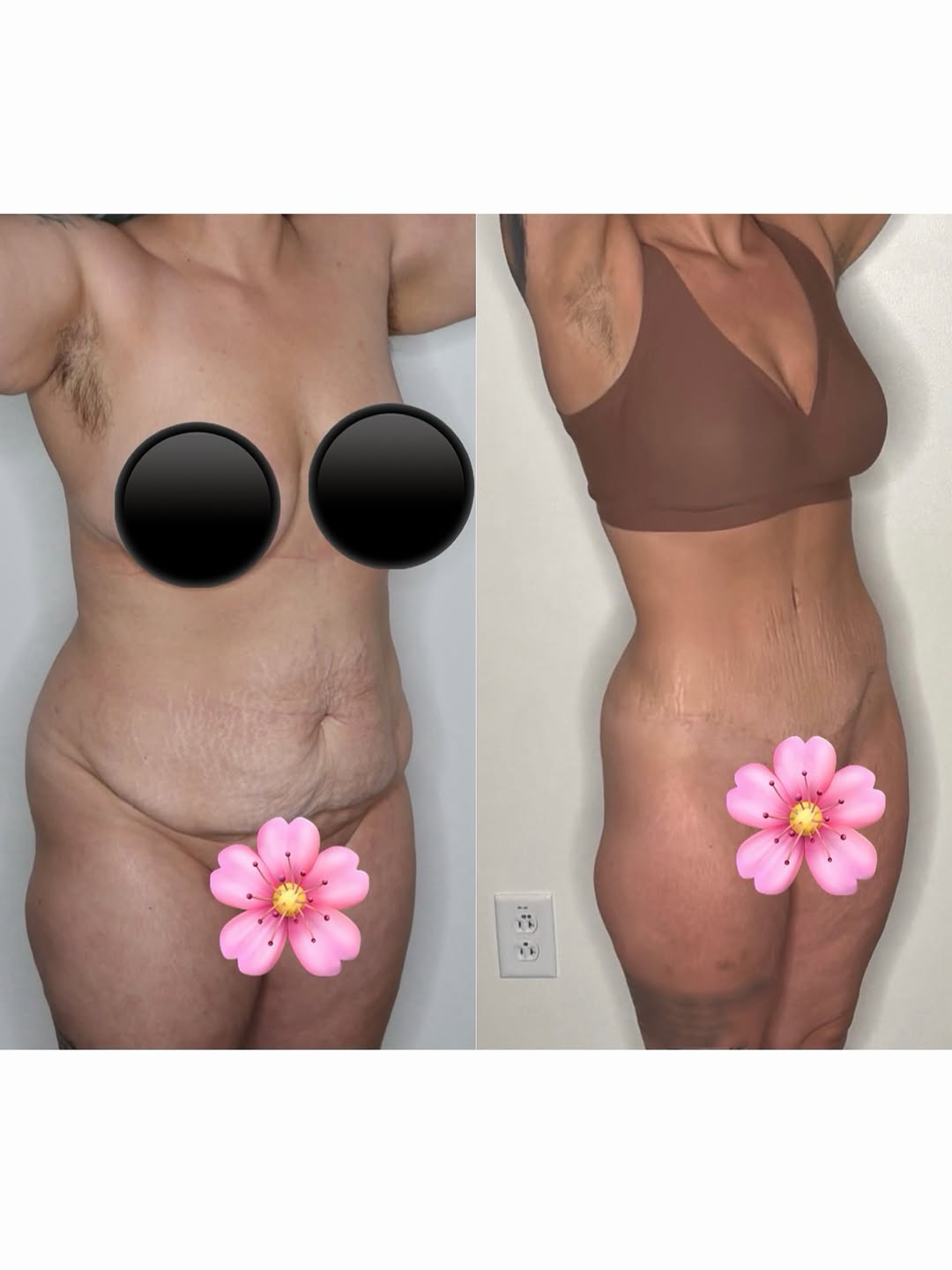 Instagram post by Dr. Jason Gardenier: ABDOMINOPLASTY: Long term results matter! Our lovely patient is shown here over 2 years after abdominoplasty. This procedure aims to remove …