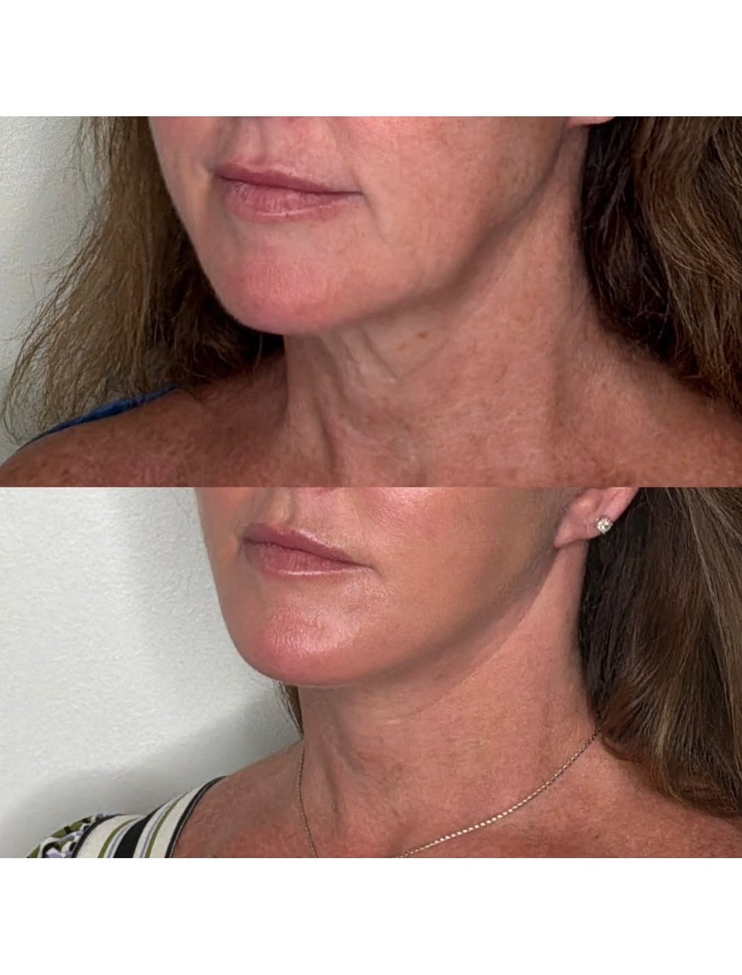 Instagram post by Dr. Jason Gardenier: FACELIFT AND NECKLIFT: Our patient is shown here 4 weeks after a facelift and necklift with central facial fat grafting. Modern techniques o…
