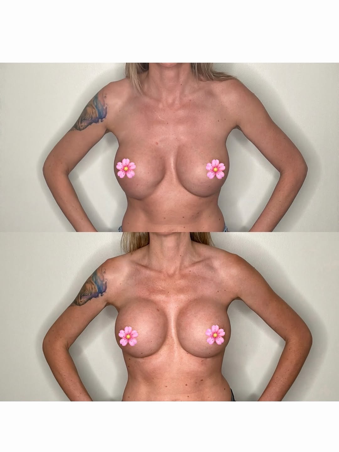 Instagram post by Dr. Jason Gardenier: BREAST REVISION/MALPOSITION REPAIR: Our lovely patient is shown here 1 month after after bilateral breast implant removal and replacement an…