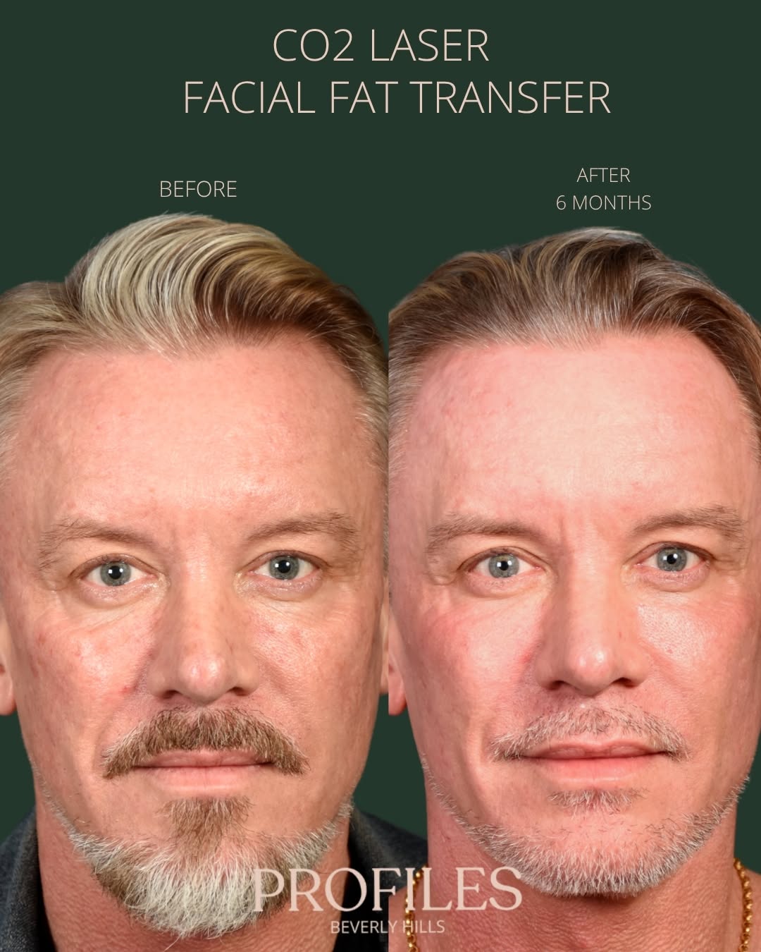 Instagram post by Dr. Jason Litner: Six months after CO₂ laser resurfacing + facial fat transfer ✨ By addressing skin texture, tone, and under-eye hollows, Dr. Litner and Dr. S…