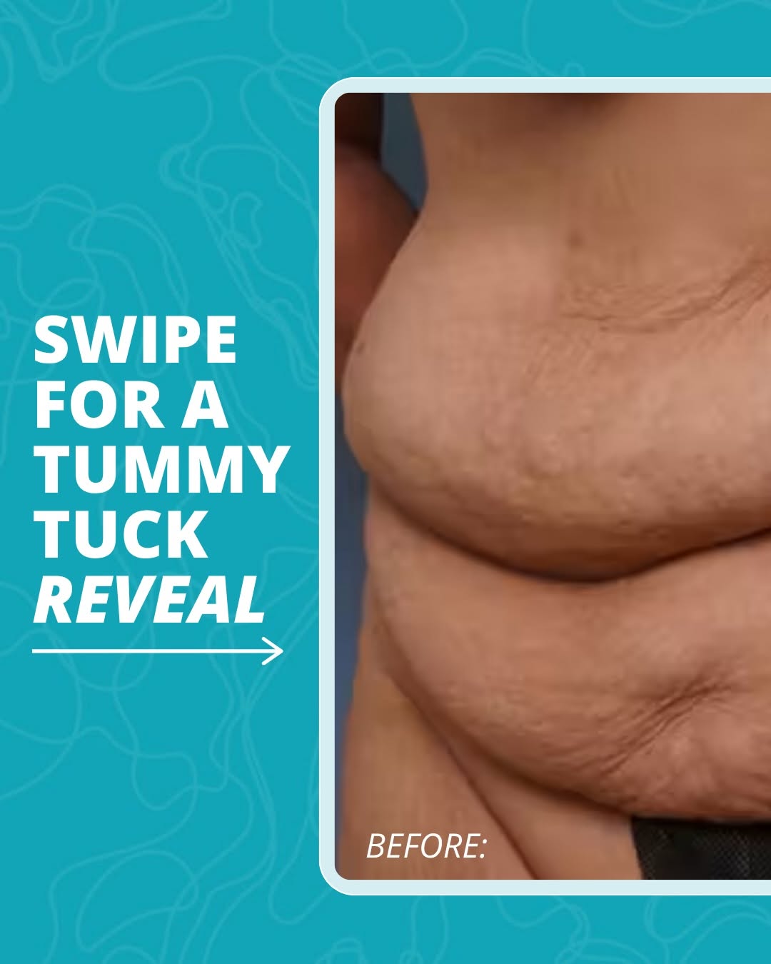 Instagram post by Dr. Jason Pozner: A before & after can show the result, but there’s more to the procedure behind it. ✨ A tummy tuck, or abdominoplasty, is designed to address…