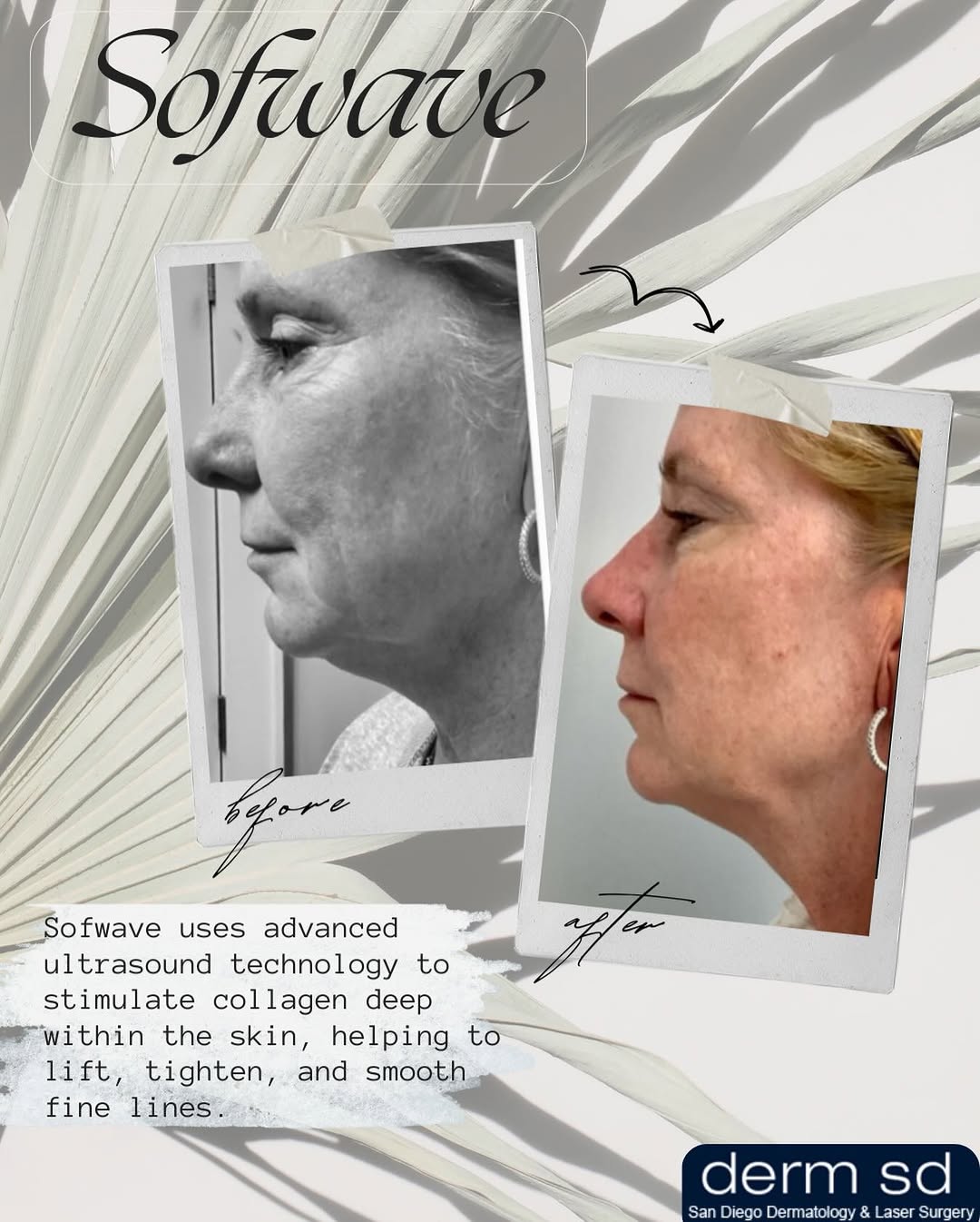 Instagram post by Dr. Jason R. Lupton: Real results , no surgery. Lift and tighten — no downtime needed. ✨ #sofwavesandiego #dermatologydelmar #sandiegodermatologist