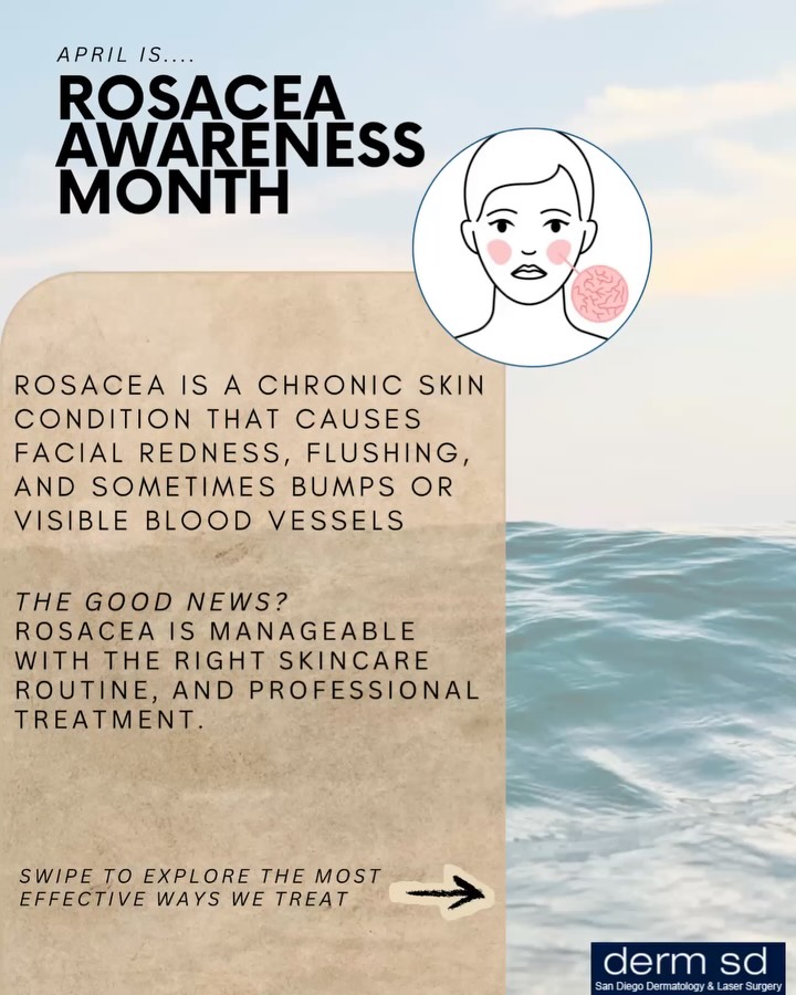 Instagram post by Dr. Jason R. Lupton: Finding what works, one treatment at a time ✨ #rosaceaawareness #rosaceatips #sandiegorosaceatreatment