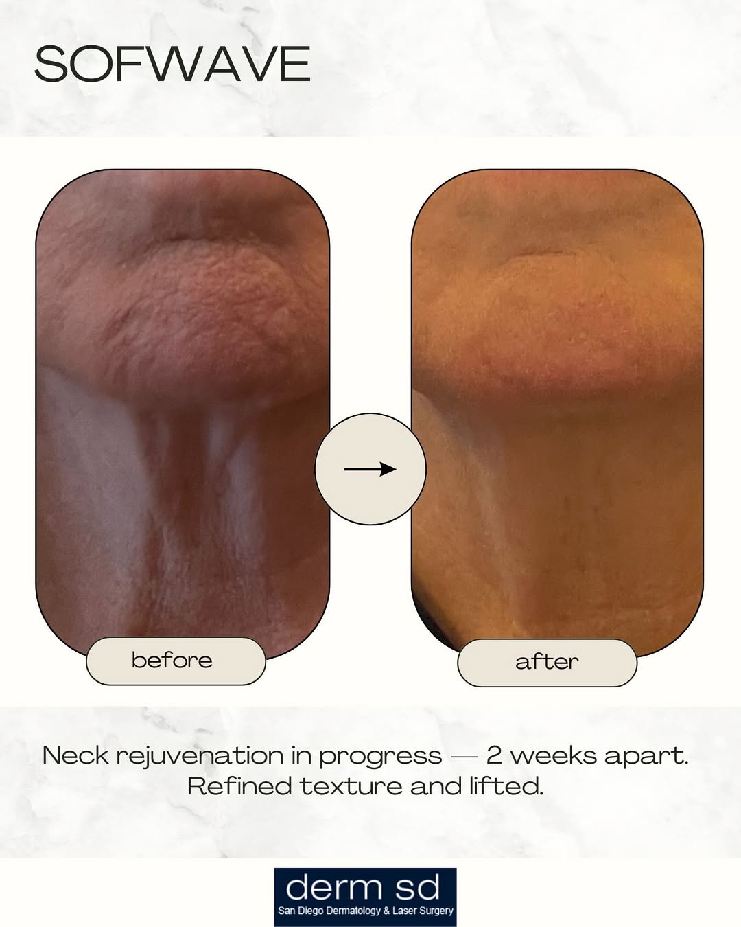 Instagram post by Dr. Jason R. Lupton: Sofwave uses advanced ultrasound technology to stimulate collagen and improve skin laxity—no needles, no downtime. #sofwavesandiego #skintig…
