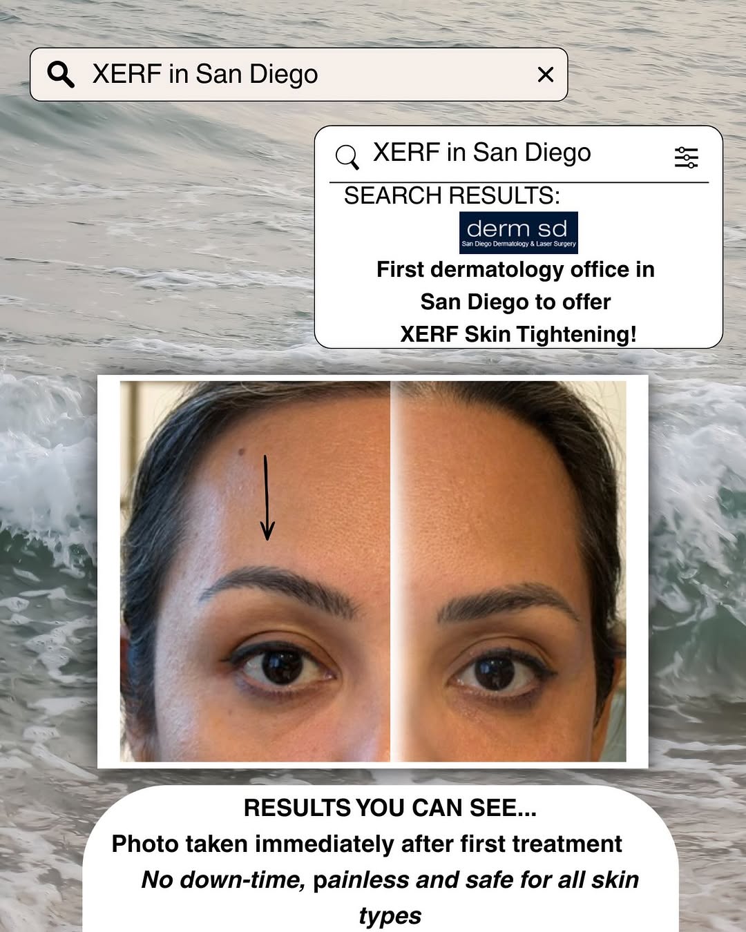 Instagram post by Dr. Jason R. Lupton: XERF has arrived and it’s a game changer! Noticeable lifting and tightening, no down-time, painless, and safe for all skin types. If you’ve …