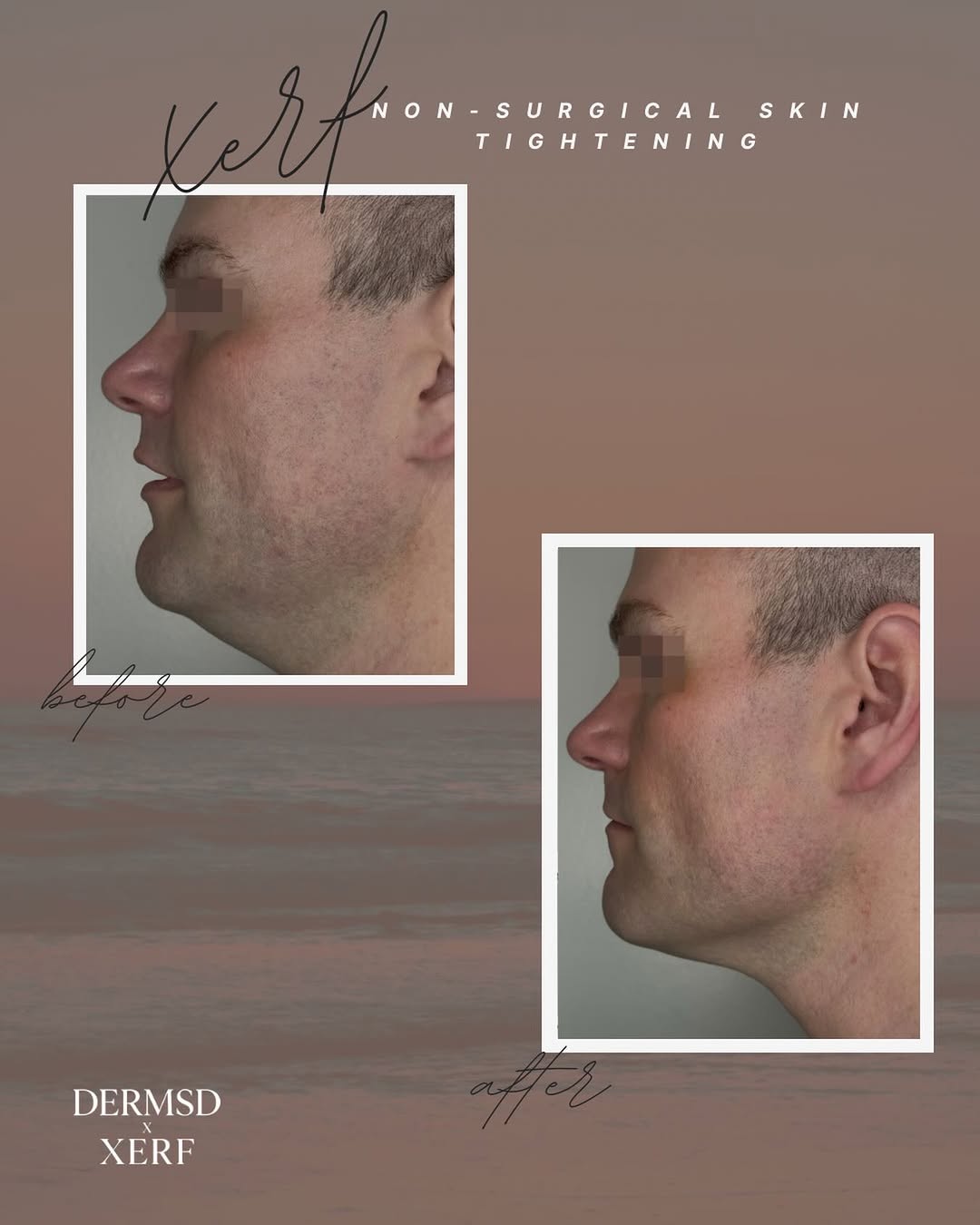 Instagram post by Dr. Jason R. Lupton: Firmer, smoother-looking skin—no surgery required. Discover the benefits of XERF skin tightening.#xerfsandiego #dermatologistsandiego #xerfo…