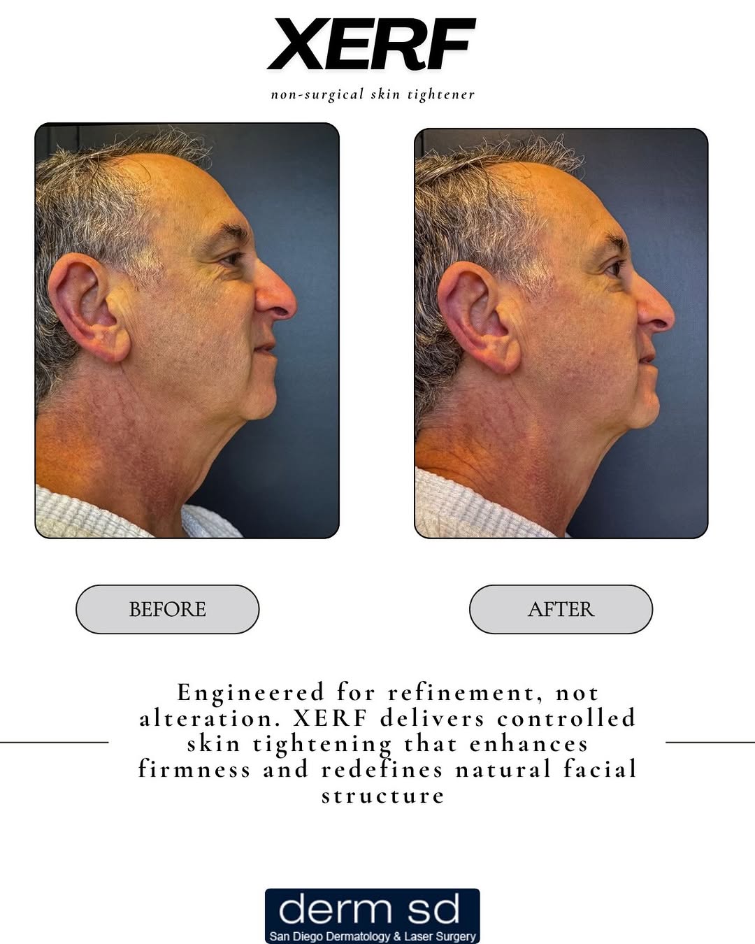 Instagram post by Dr. Jason R. Lupton: Neck laxity improvement using XERF . No pain . No numbing needed. #xerfsandiego #nonsurgicalsandiego #skintighteningsandiego #xerfskintighte…