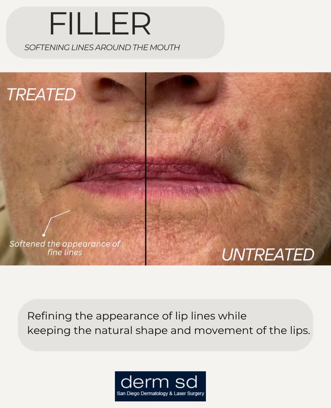Instagram post by Dr. Jason R. Lupton: A natural approach to softening the lines around the mouth while maintaining the patient’s natural expression and features. #fillersandiego …