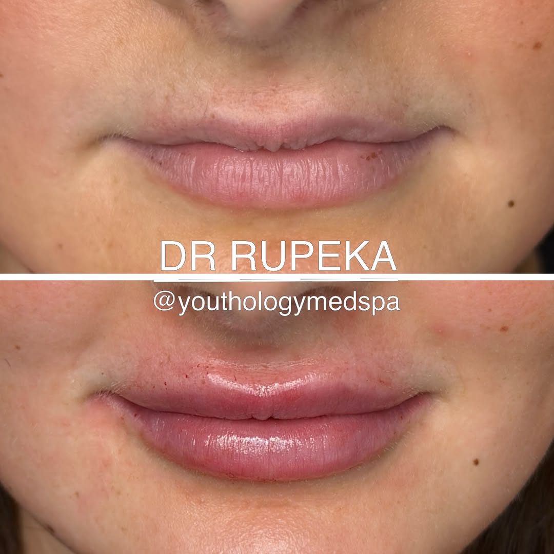 Instagram post by Dr. Jason Rupeka, DO: LIP GOD . . I saw this patient yesterday for a lip enhancement. At this point in her life, she has not had any injectables done. Through our…