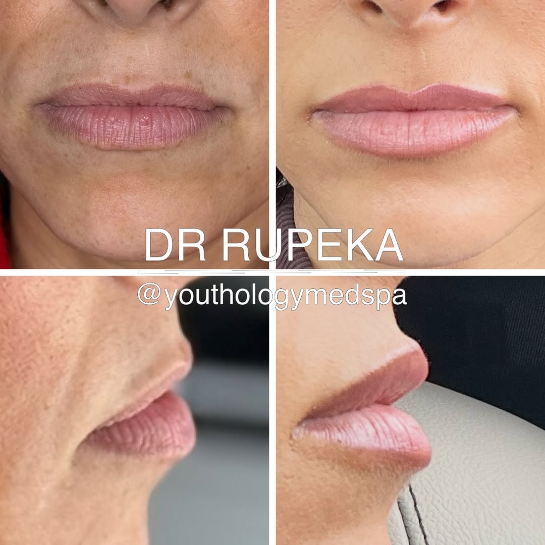 Instagram post by Dr. Jason Rupeka, DO: LIP GOD . . Love this side profile!!!! . . #lipgod #bestaestheticinjectors #lipfillers #lipfiller