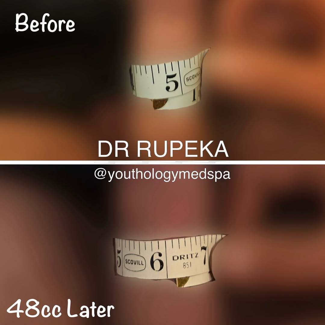 Instagram post by Dr. Jason Rupeka, DO: A Package for Your Package . . This is an example of a male enhancement using PMMA. . . I used my Sub-Dartos Intrafascial Technique to place…