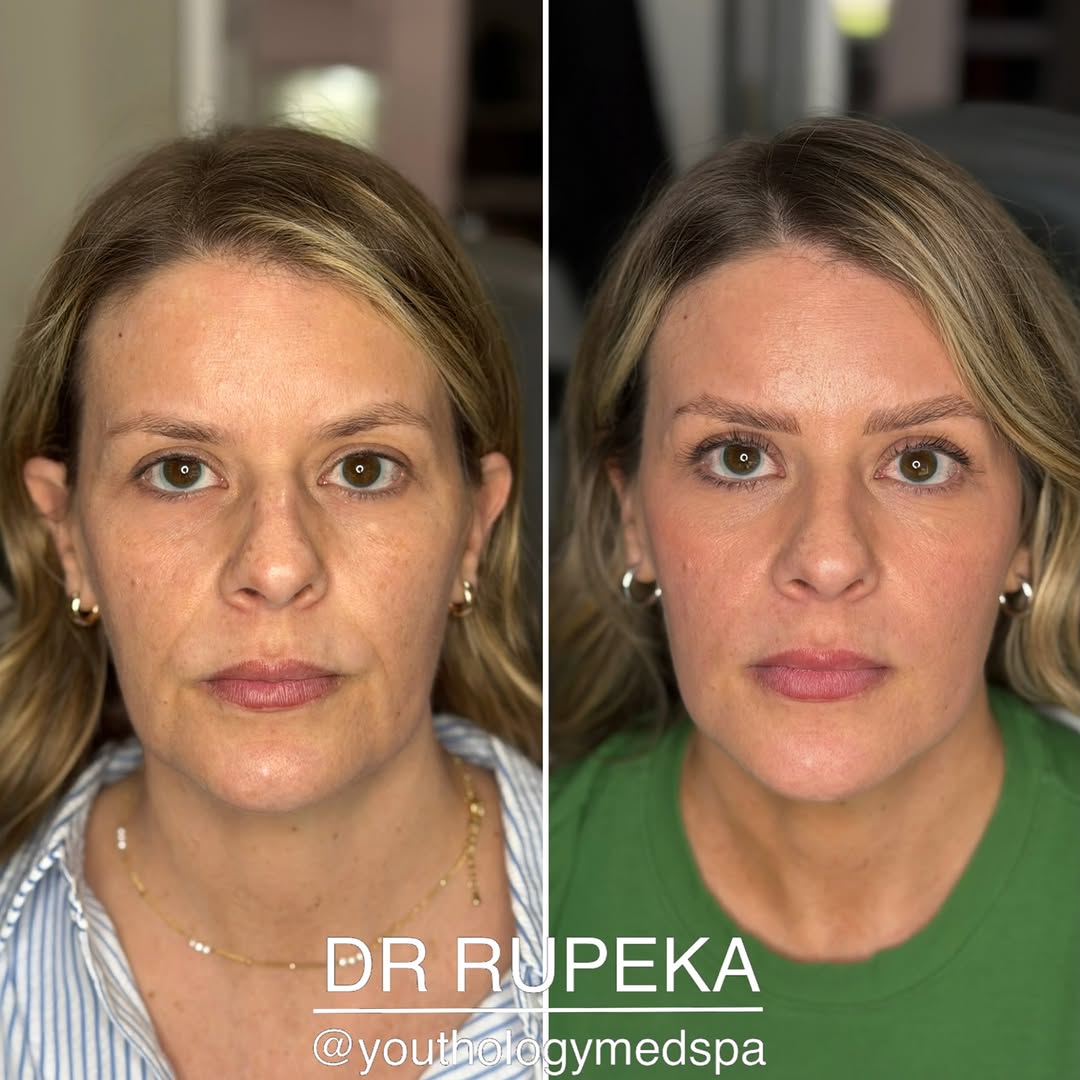 Instagram post by Dr. Jason Rupeka, DO: RADIENT . . This is a perfect example of being “lit from within” . . This patient has been seeing me over the past 6 months to get ready for…