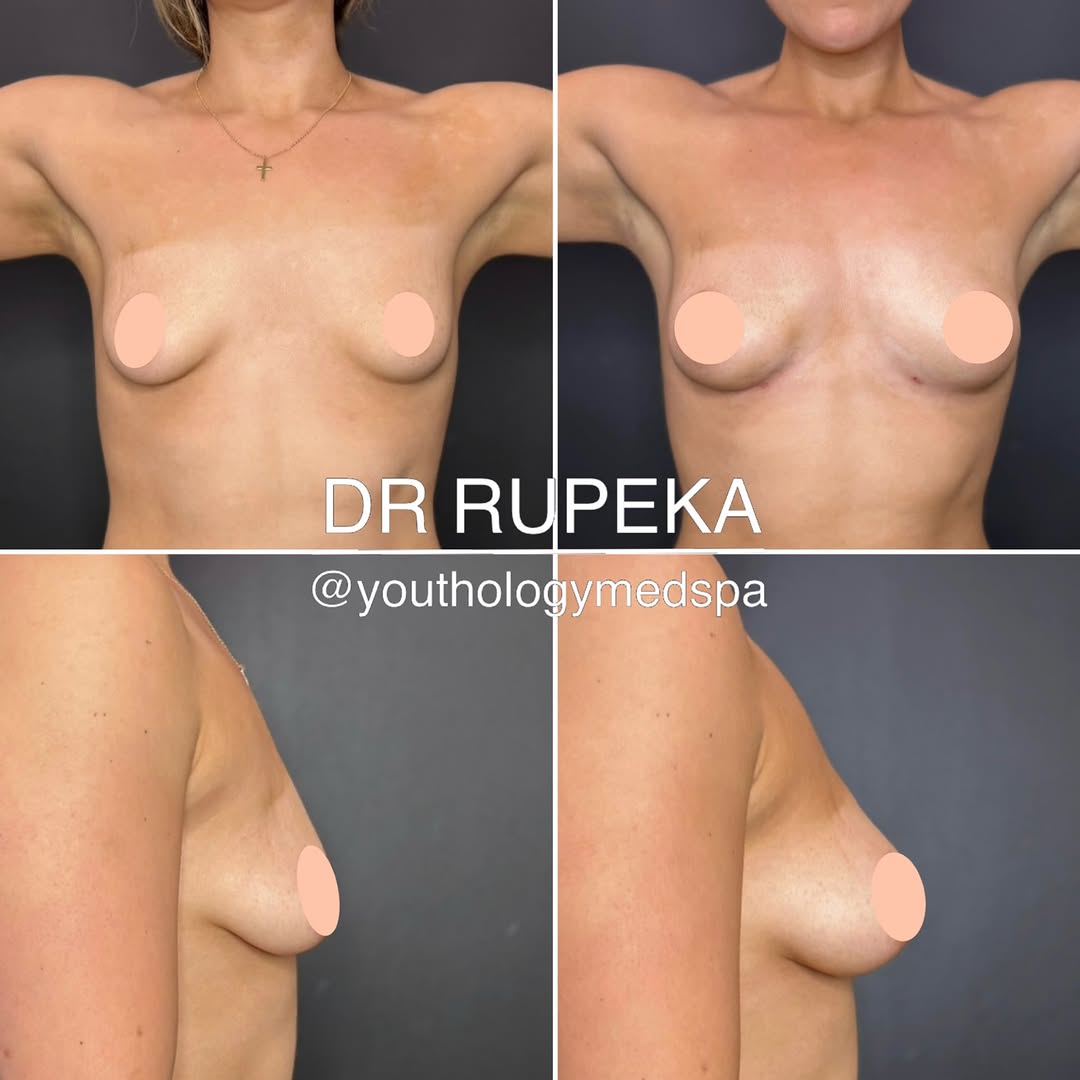 Instagram post by Dr. Jason Rupeka, DO: BREAST VOLUME REPLACEMENT USING 200CC OF ALLOCLAE . . What actually happens with alloClae? The donor fat cells are devitalized (they are not…