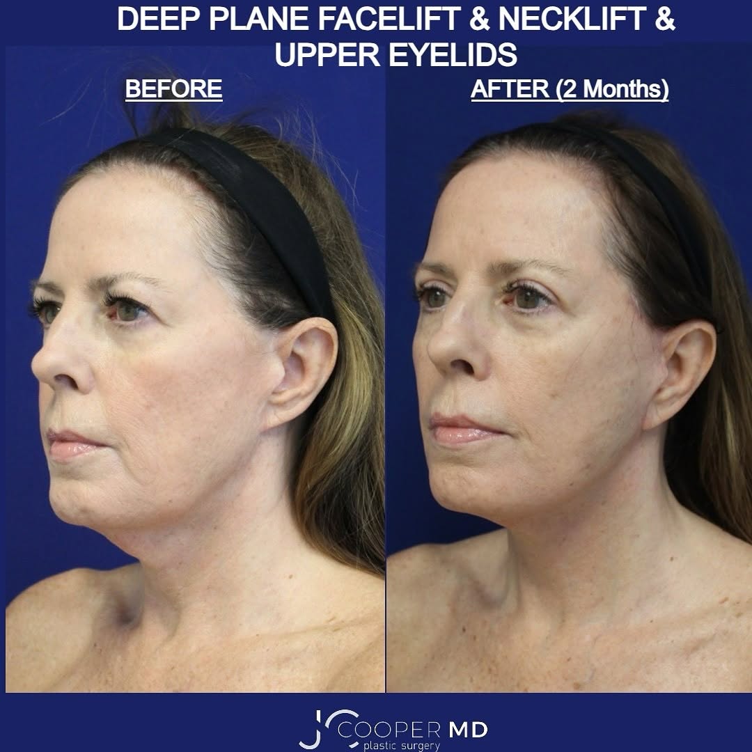 Instagram post by Dr. Jason S. Cooper: ✨A deep plane facelift is the secret to looking youthful. ✨This technique lifts the deeper layers of the face, not just the skin—giving you …