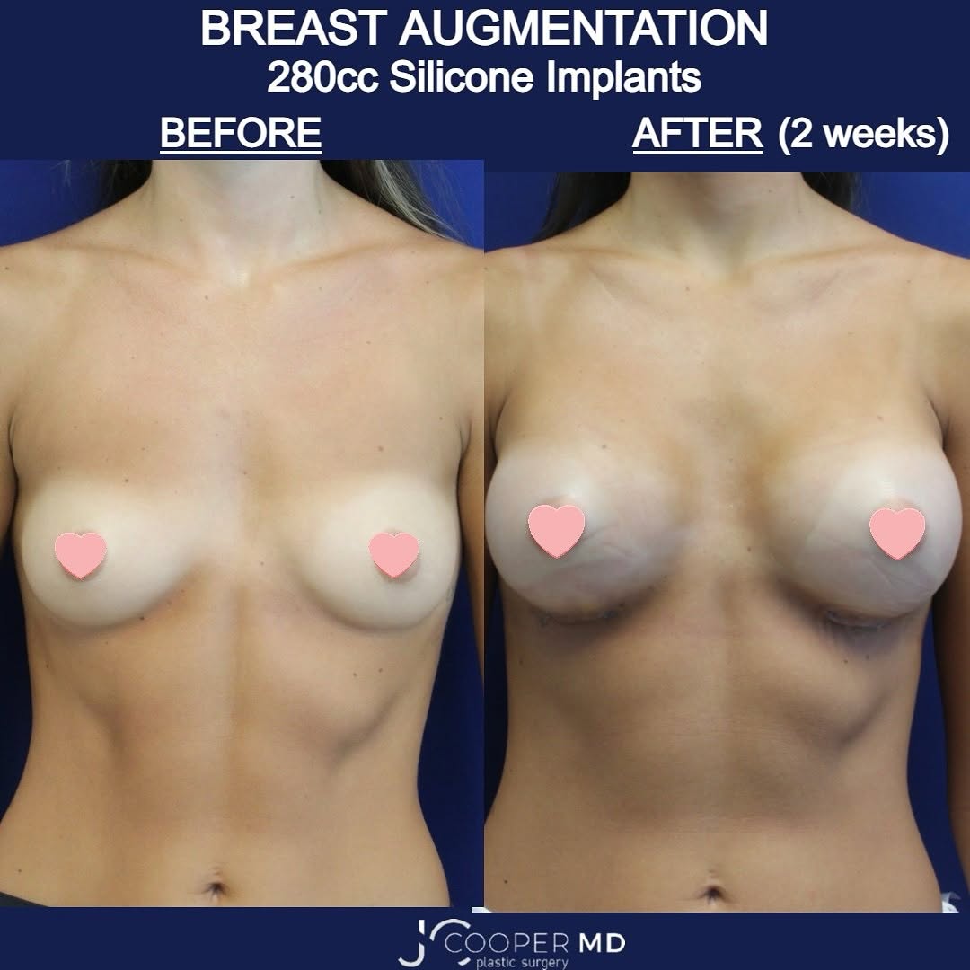 Instagram post by Dr. Jason S. Cooper: ✨ Confidence unlocked ✨ A breast augmentation can transform not just your body, but the way you feel in it. ✨From beautiful before ➝ to stun…