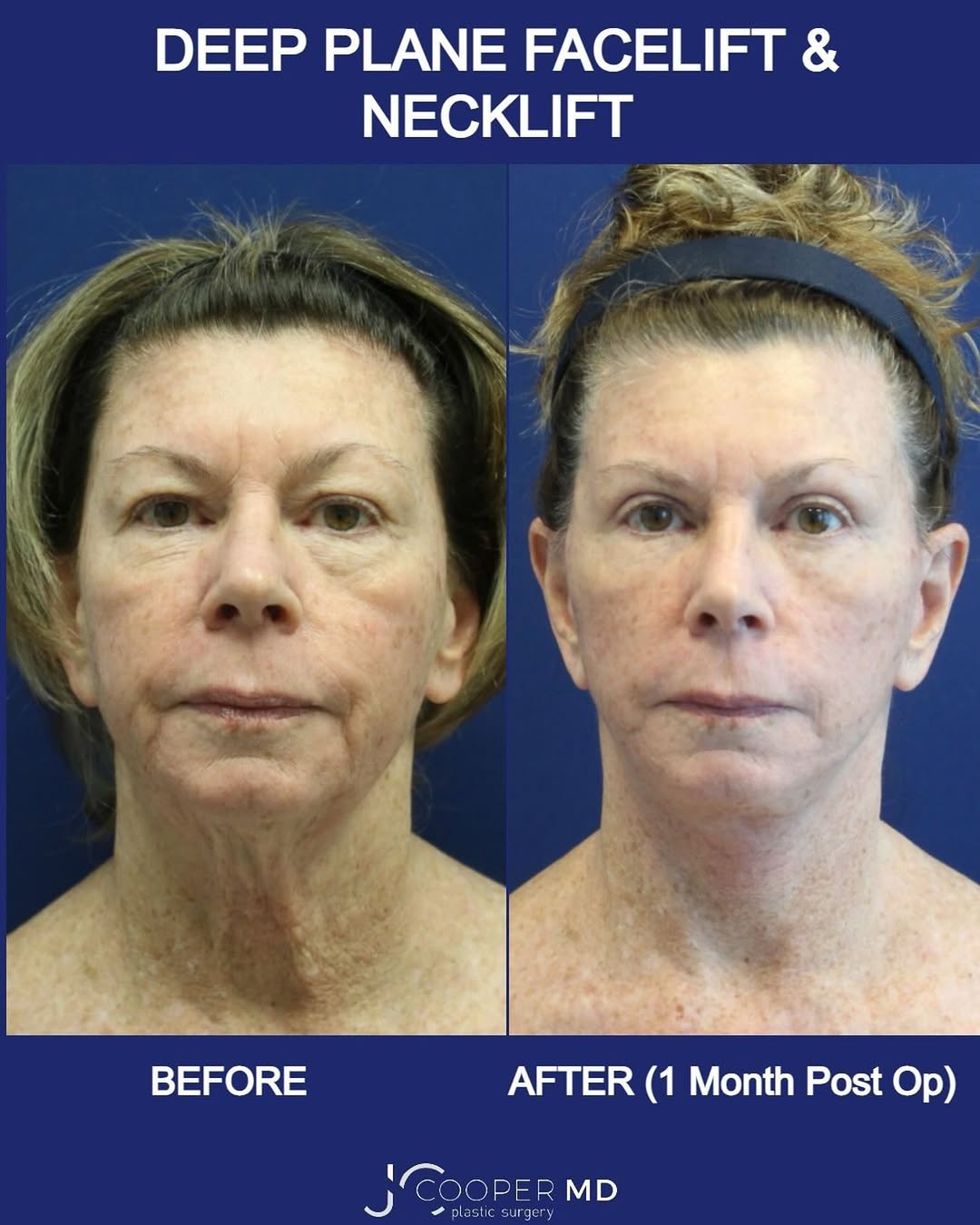 Instagram post by Dr. Jason S. Cooper: A deep plane facelift and necklift can restore youthful facial contours while maintaining natural expression and movement. Subtle, balanced,…